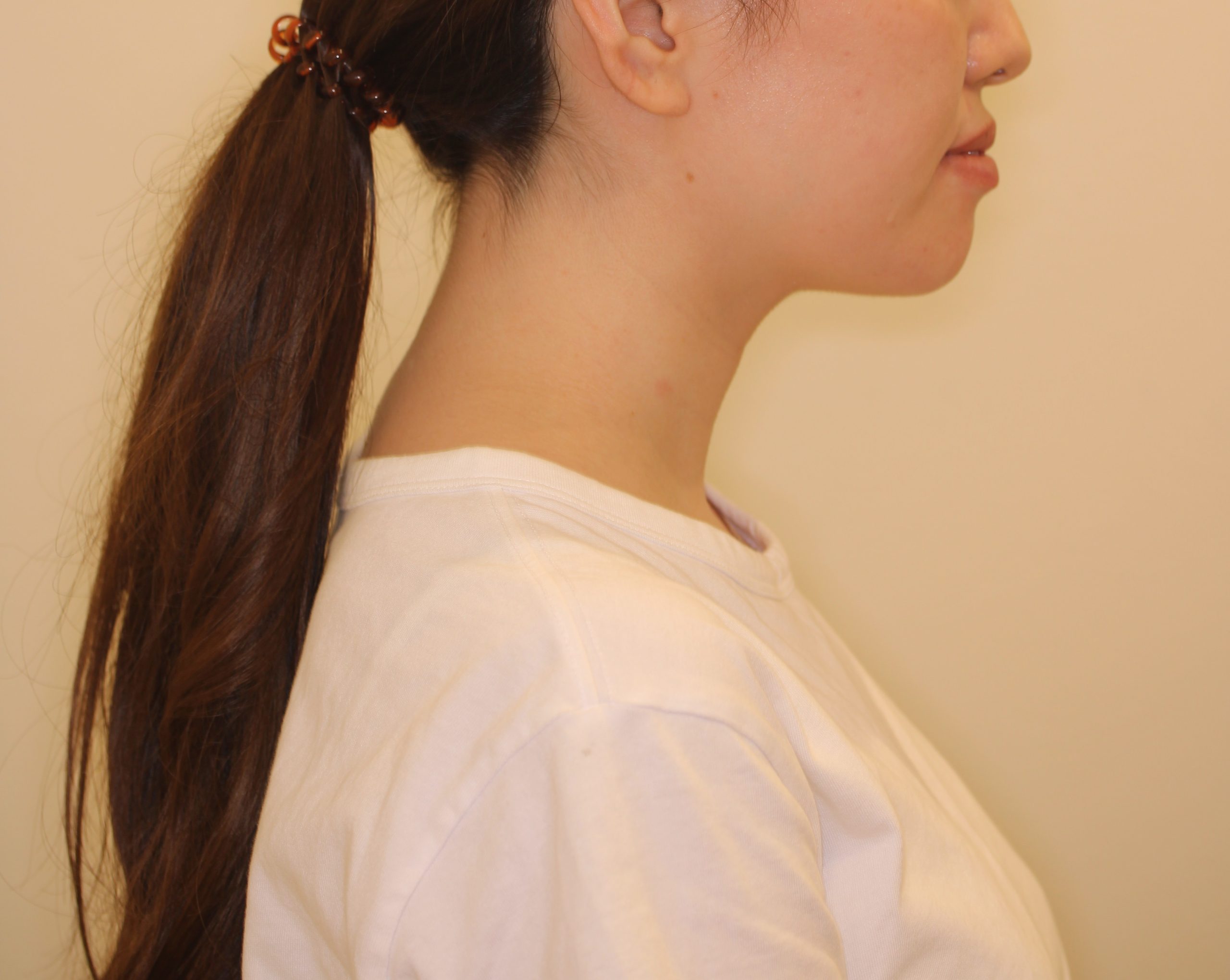 Eラインを整えたい₋ハーフリンガルの症例