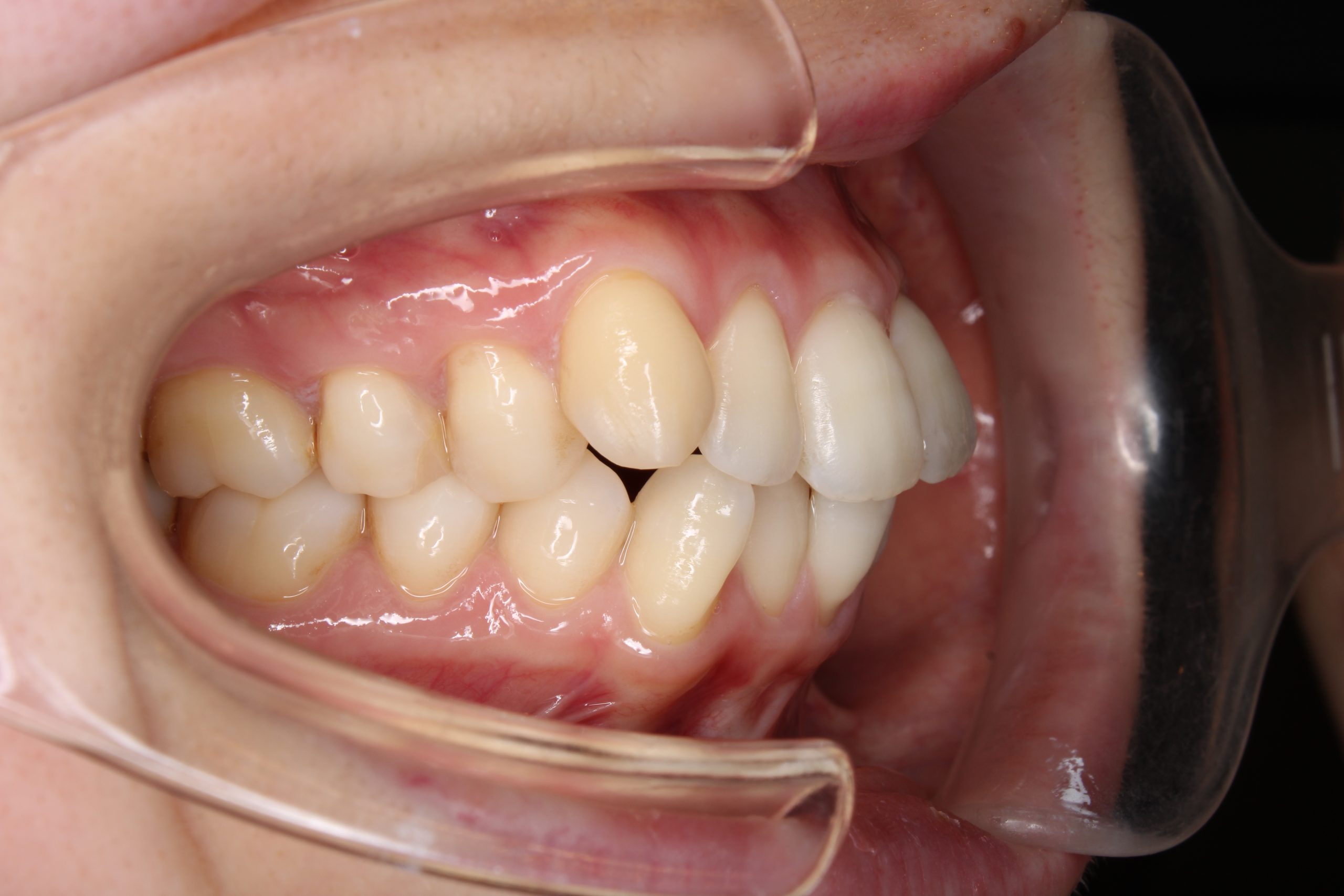 出っ歯を治したい₋ハーフリンガルの症例