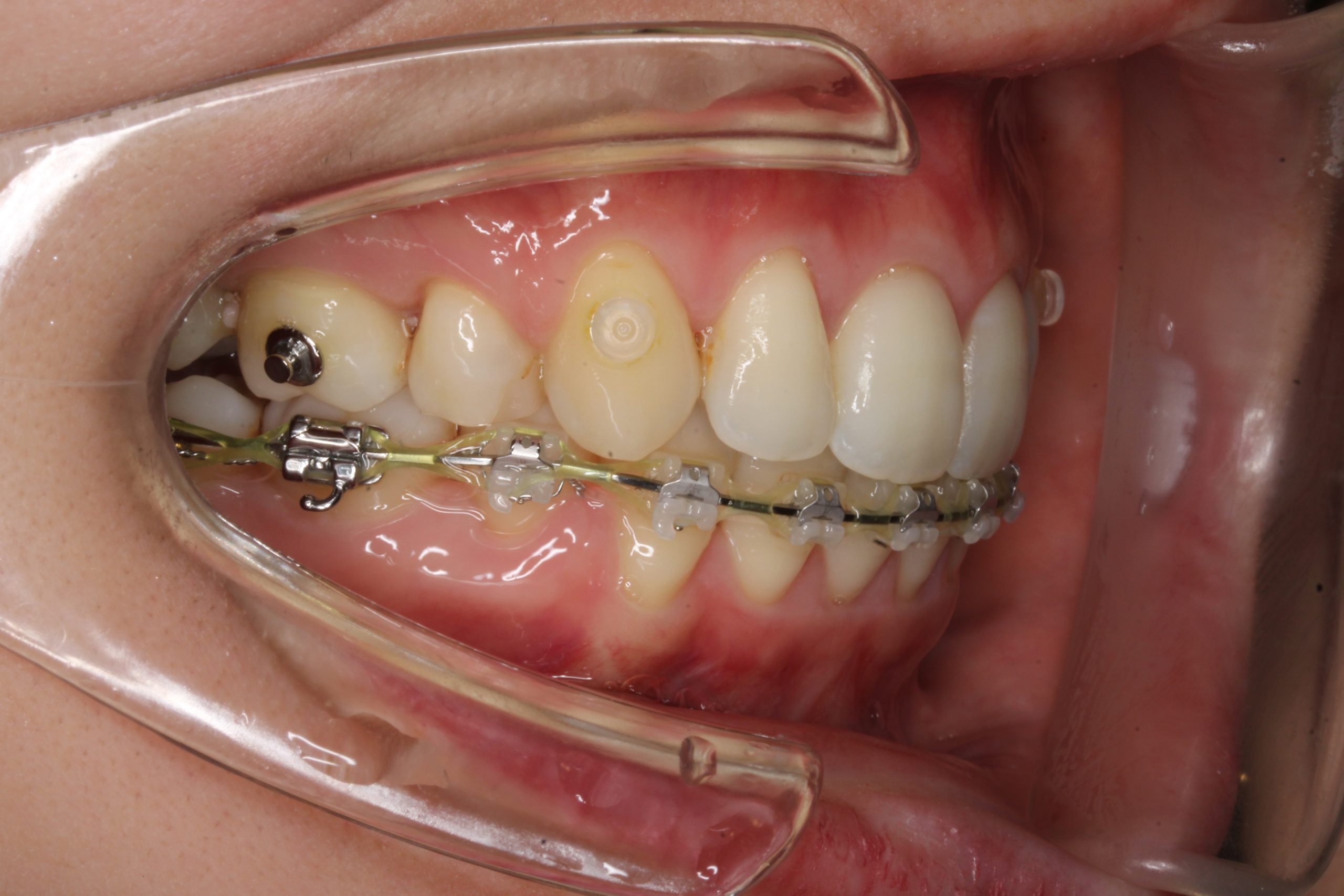 出っ歯を治したい₋ハーフリンガルの症例