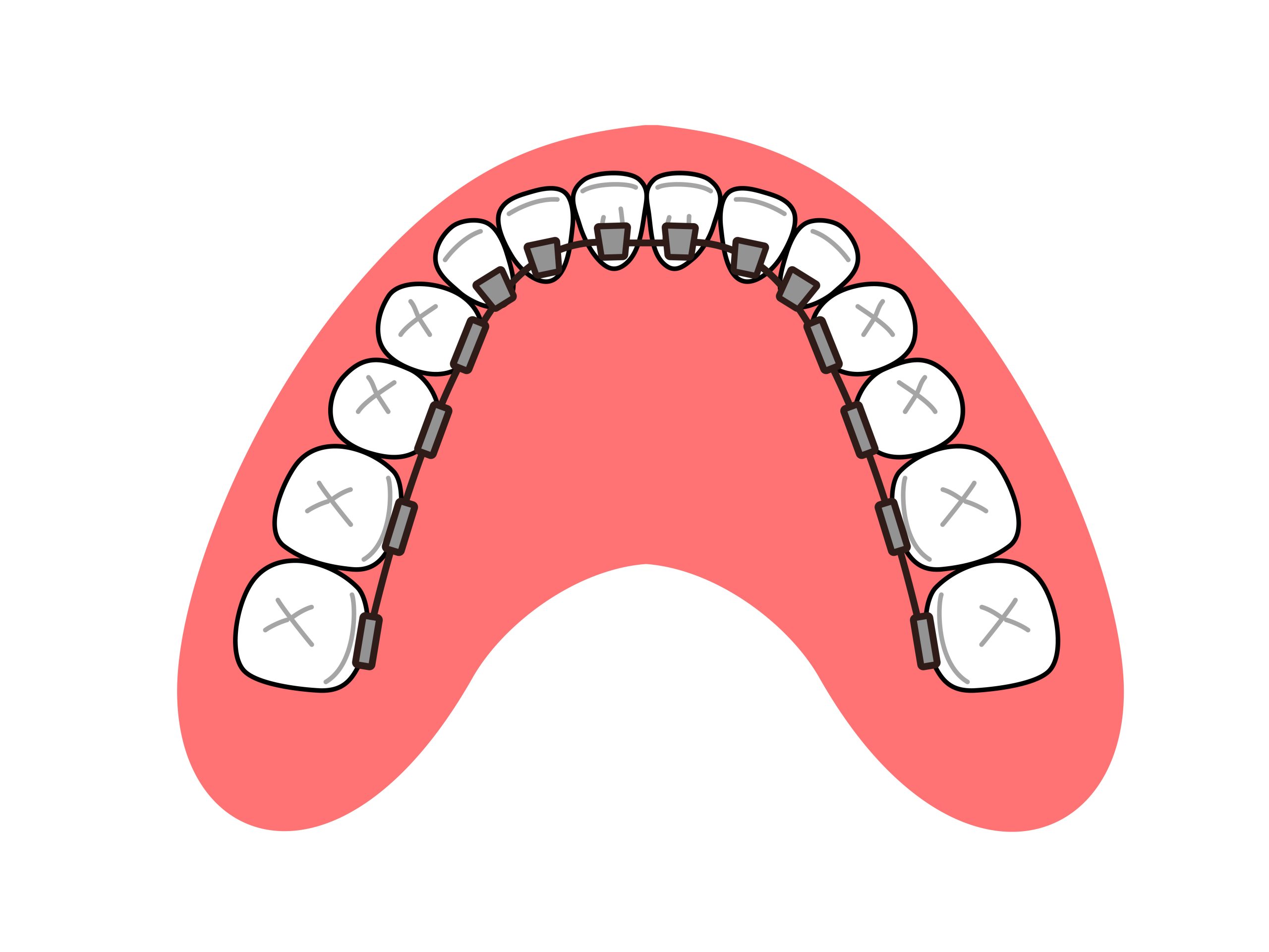 裏側矯正 リンガル矯正 矯正装置