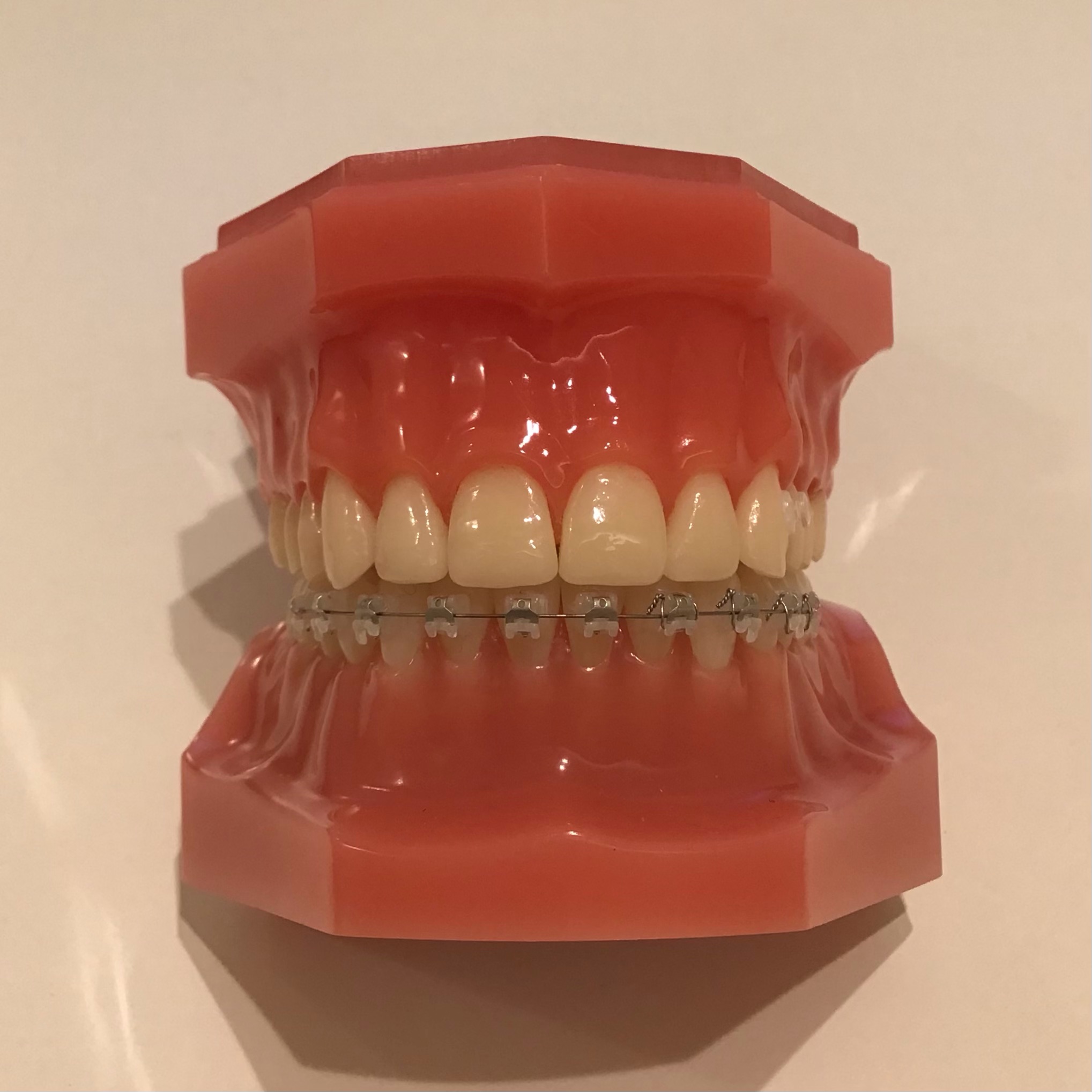 ハーフリンガル 矯正装置 滑舌