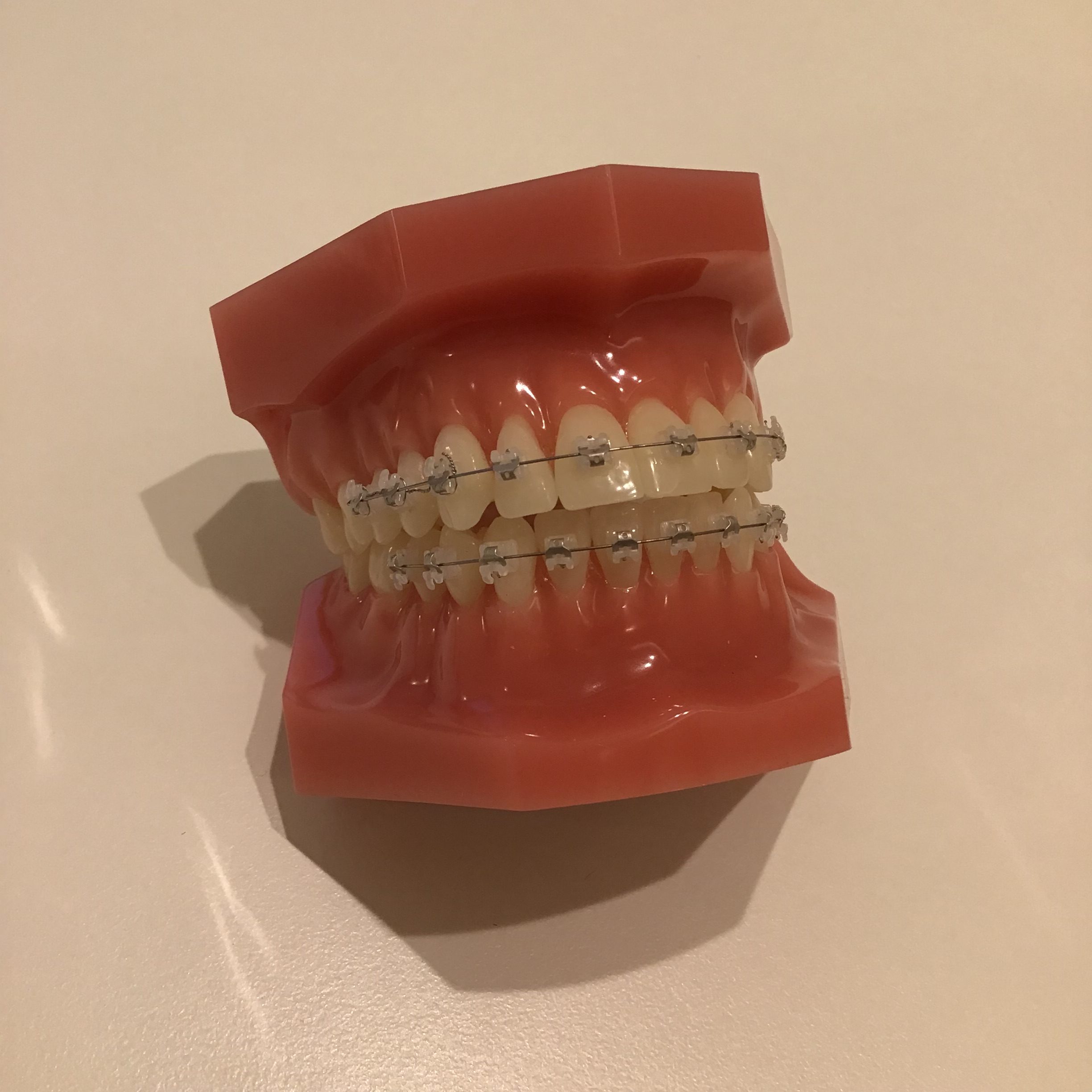 ワイヤー矯正 矯正装置 滑舌