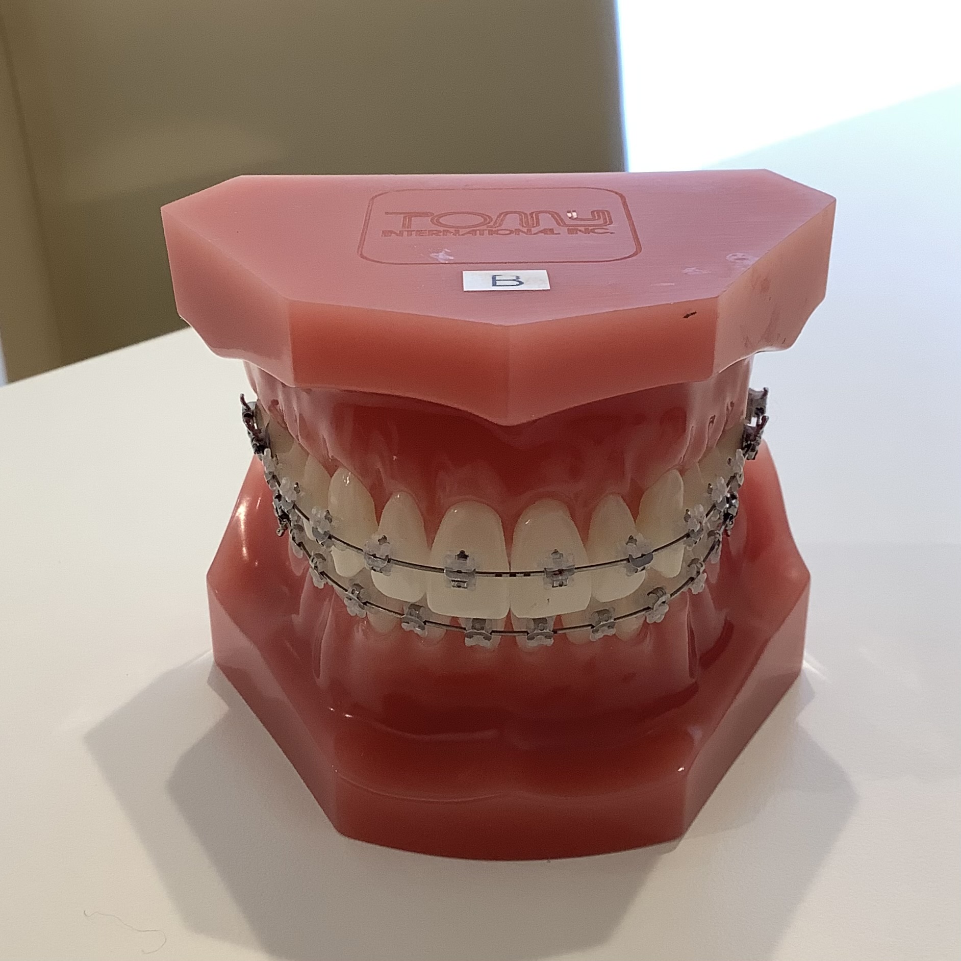 ラビアル 表側装置 口内炎