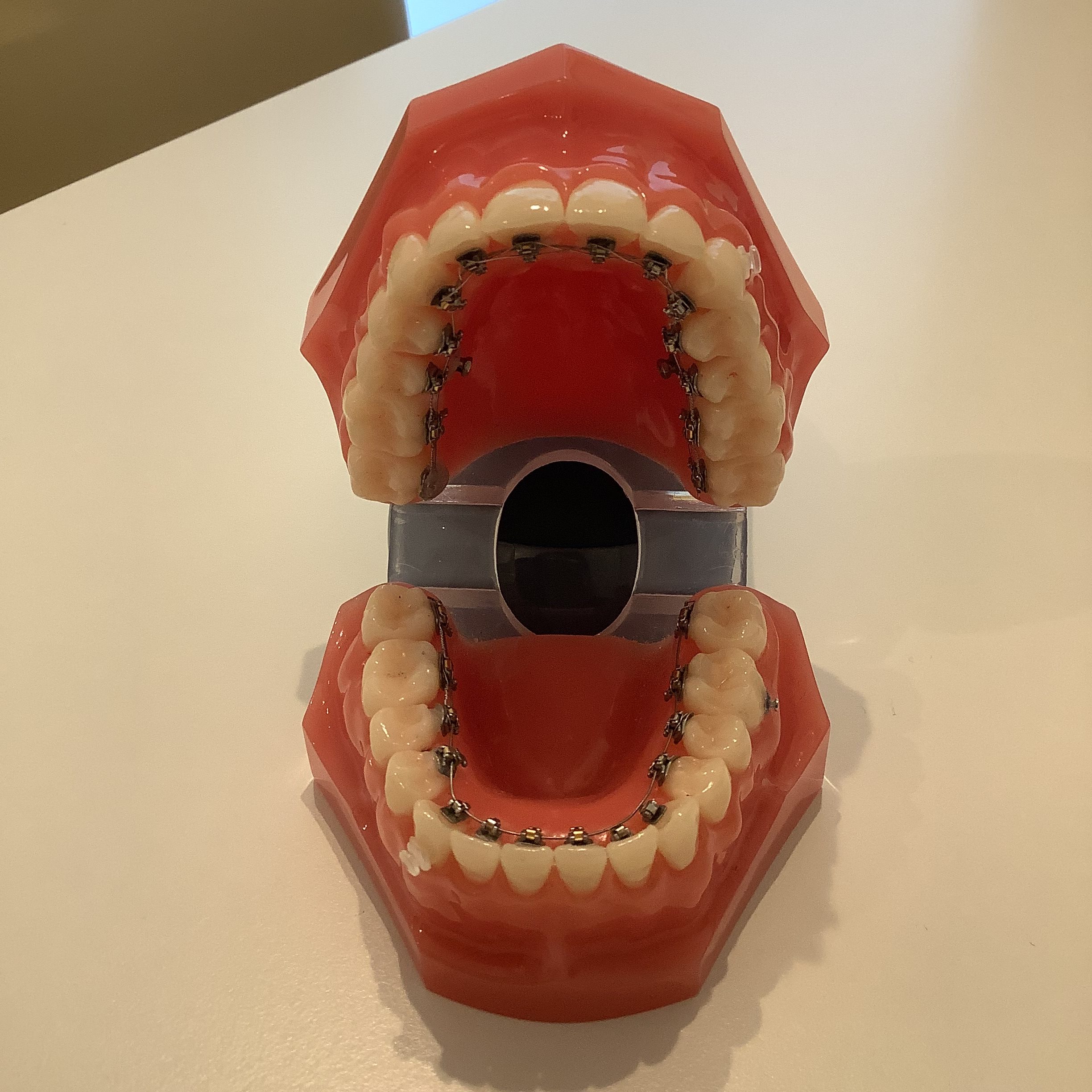 リンガル 裏側矯正 口内炎