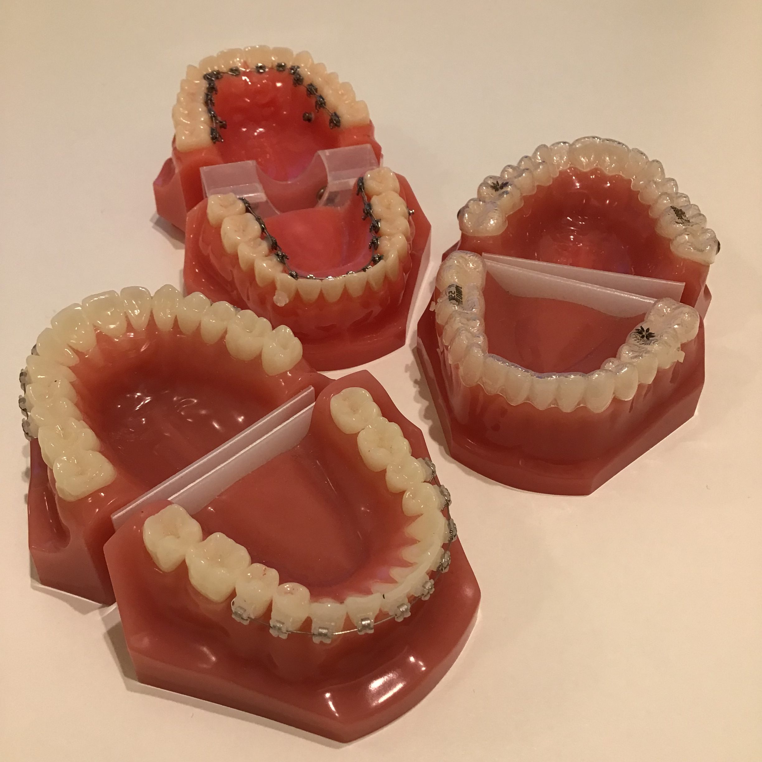 矯正装置　歯列矯正　外したい