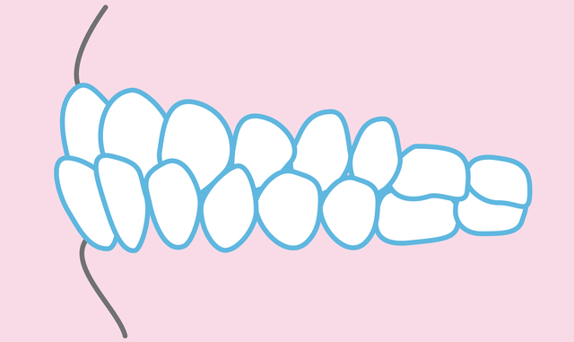 下顎前突 受け口 歯列矯正