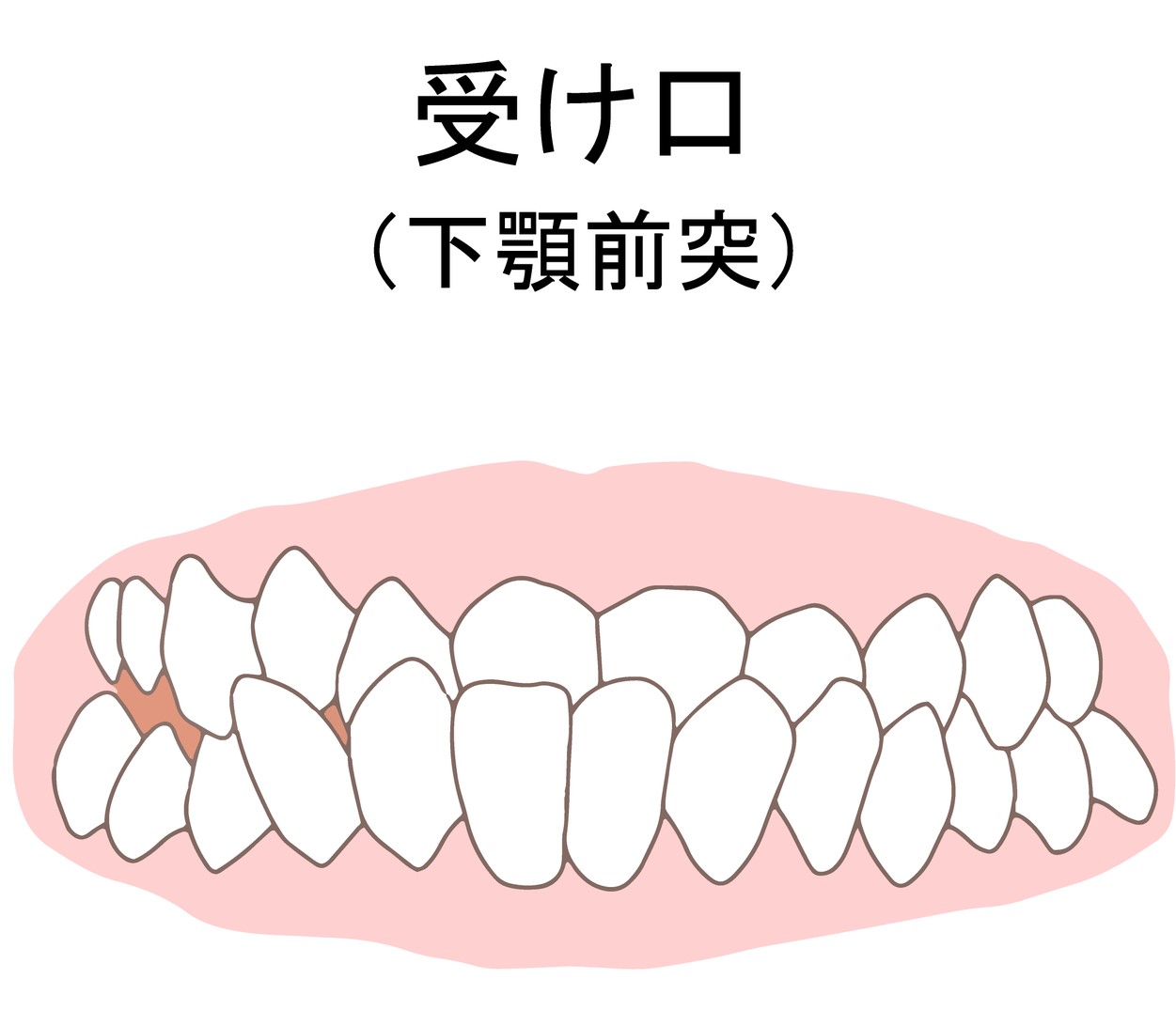 受け口　下顎前突　原因