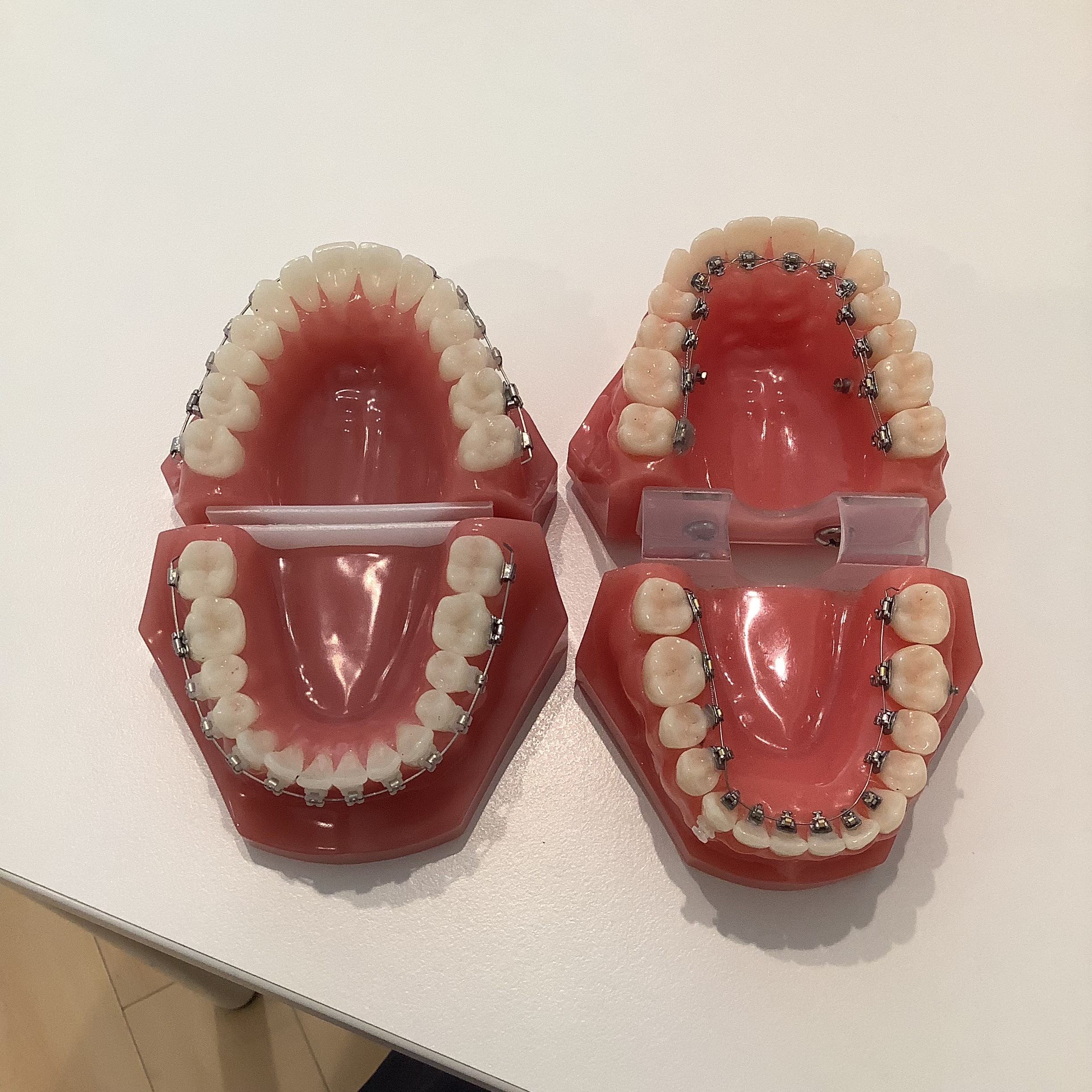 ワイヤー矯正中 矯正装置 虫歯