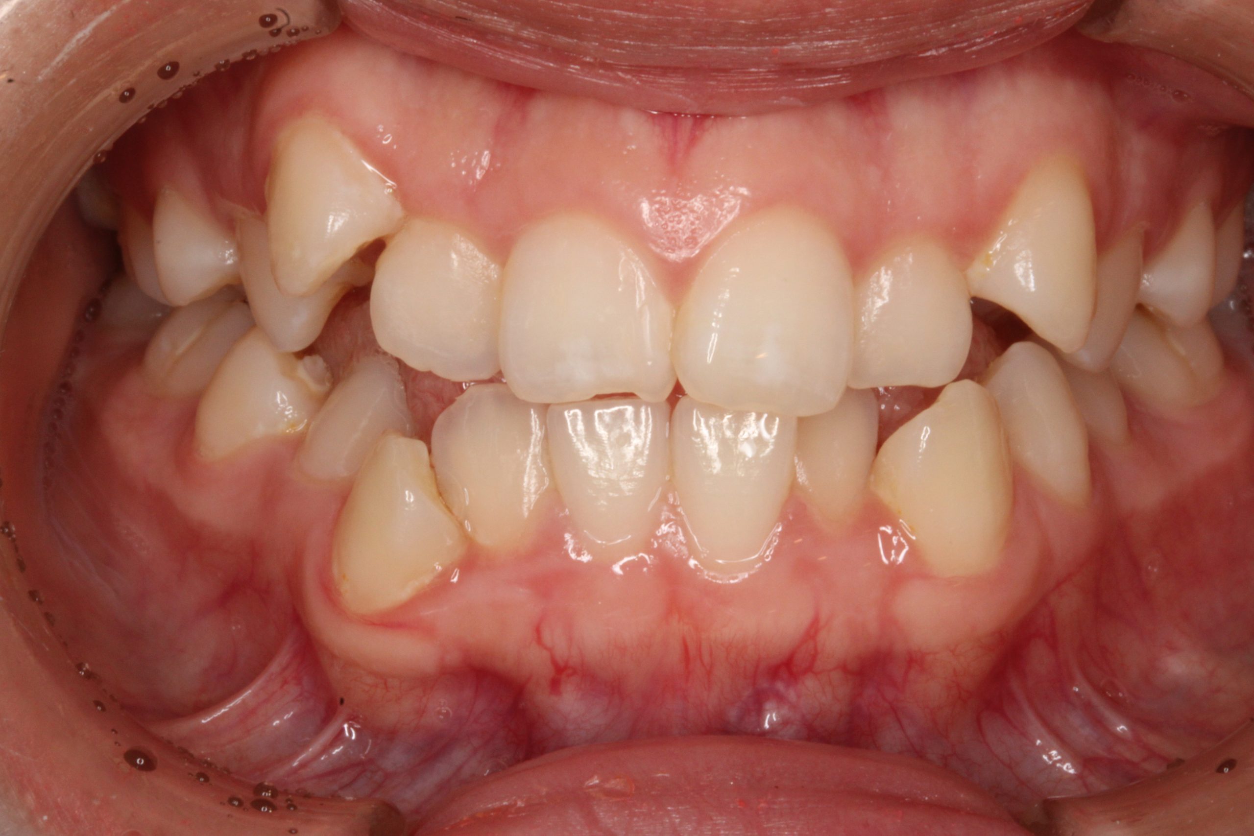 八重歯を治したい₋リンガルの症例