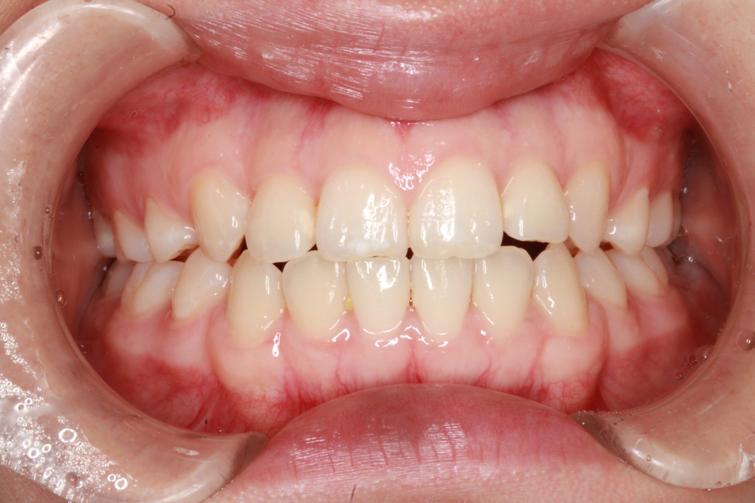 八重歯を治したい₋リンガルの症例