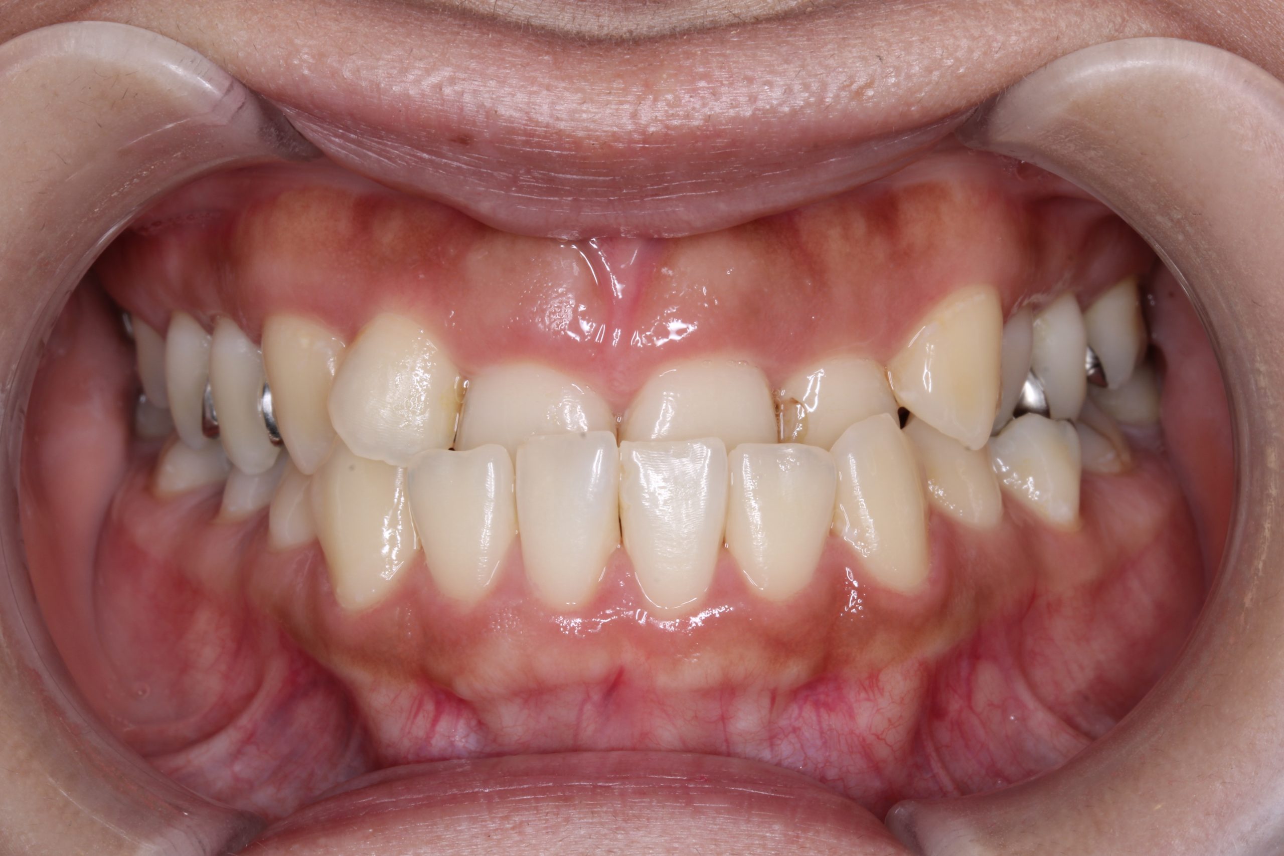 歯の凸凹を治したい‐リンガルの症例