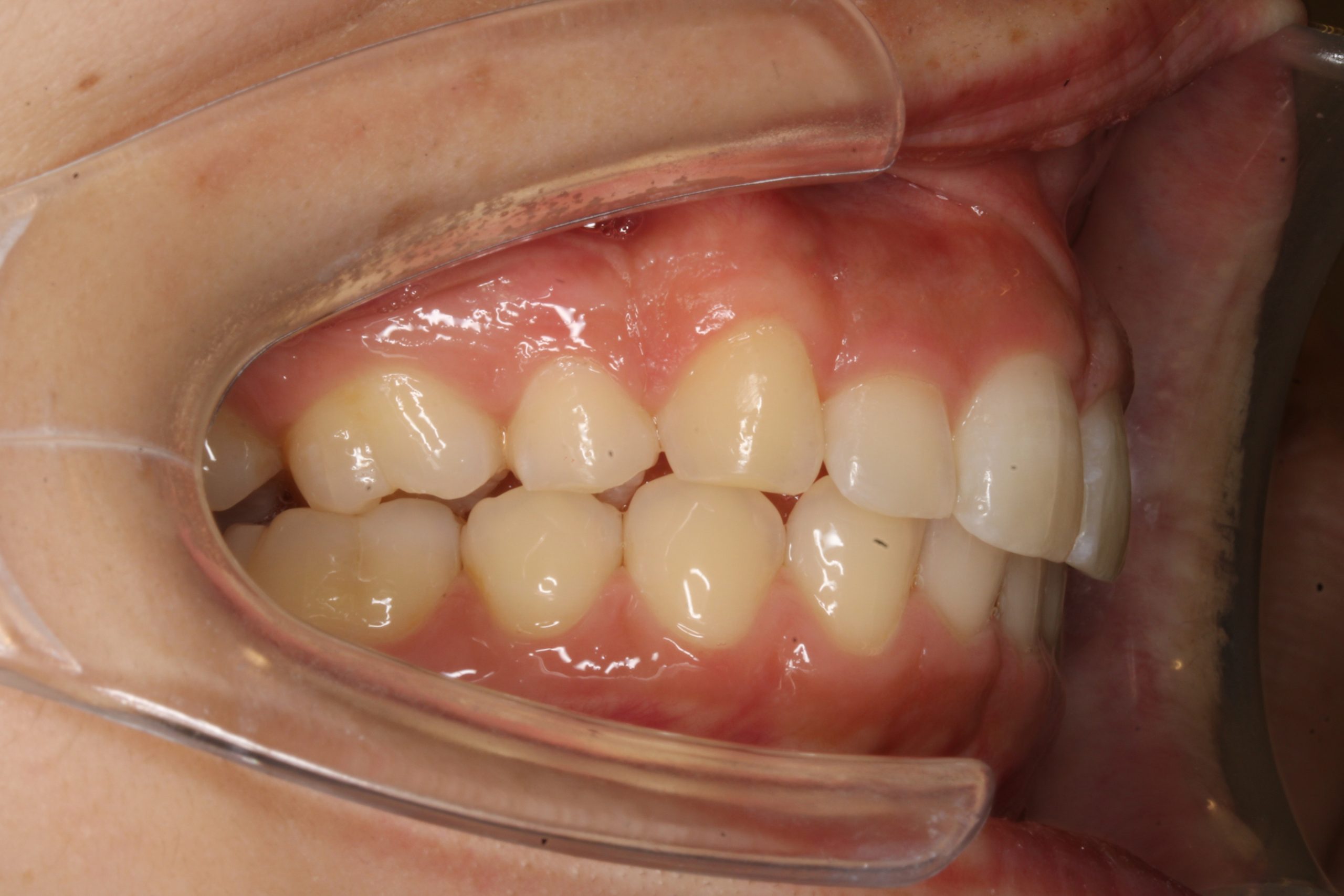 出っ歯を治したい₋ハーフリンガルの症例