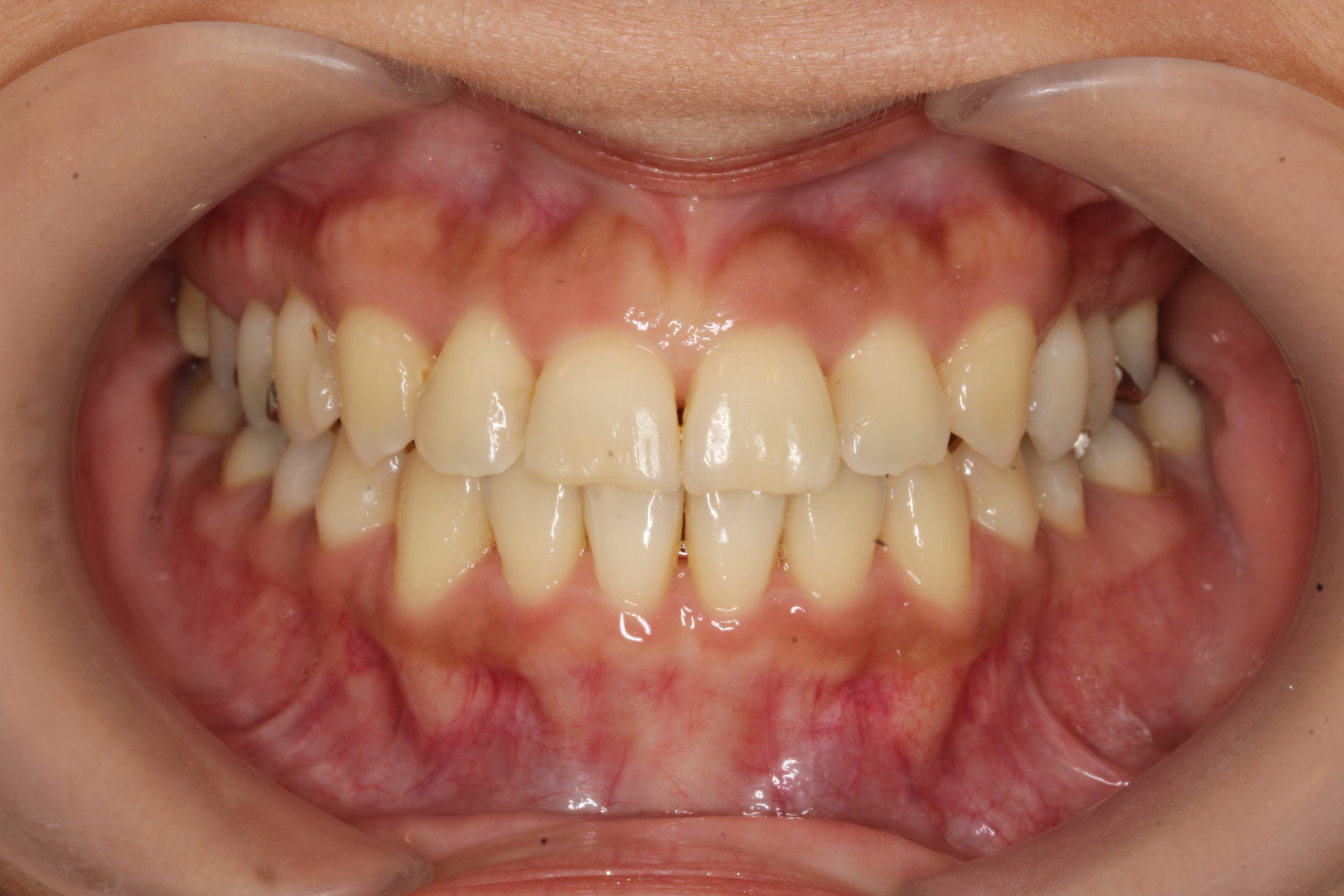 歯の凸凹を治したい‐リンガルの症例