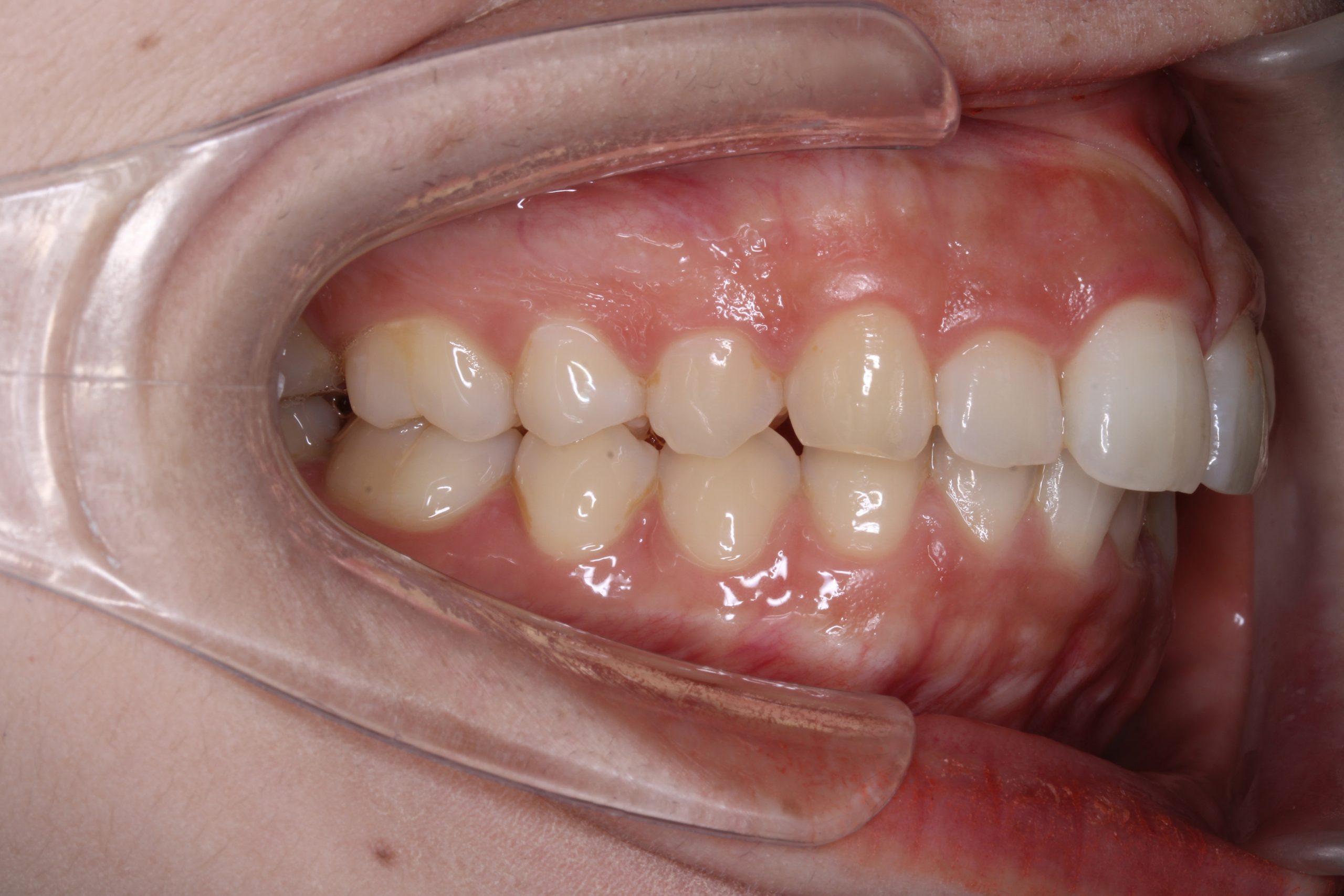 出っ歯を治したい₋ハーフリンガルの症例