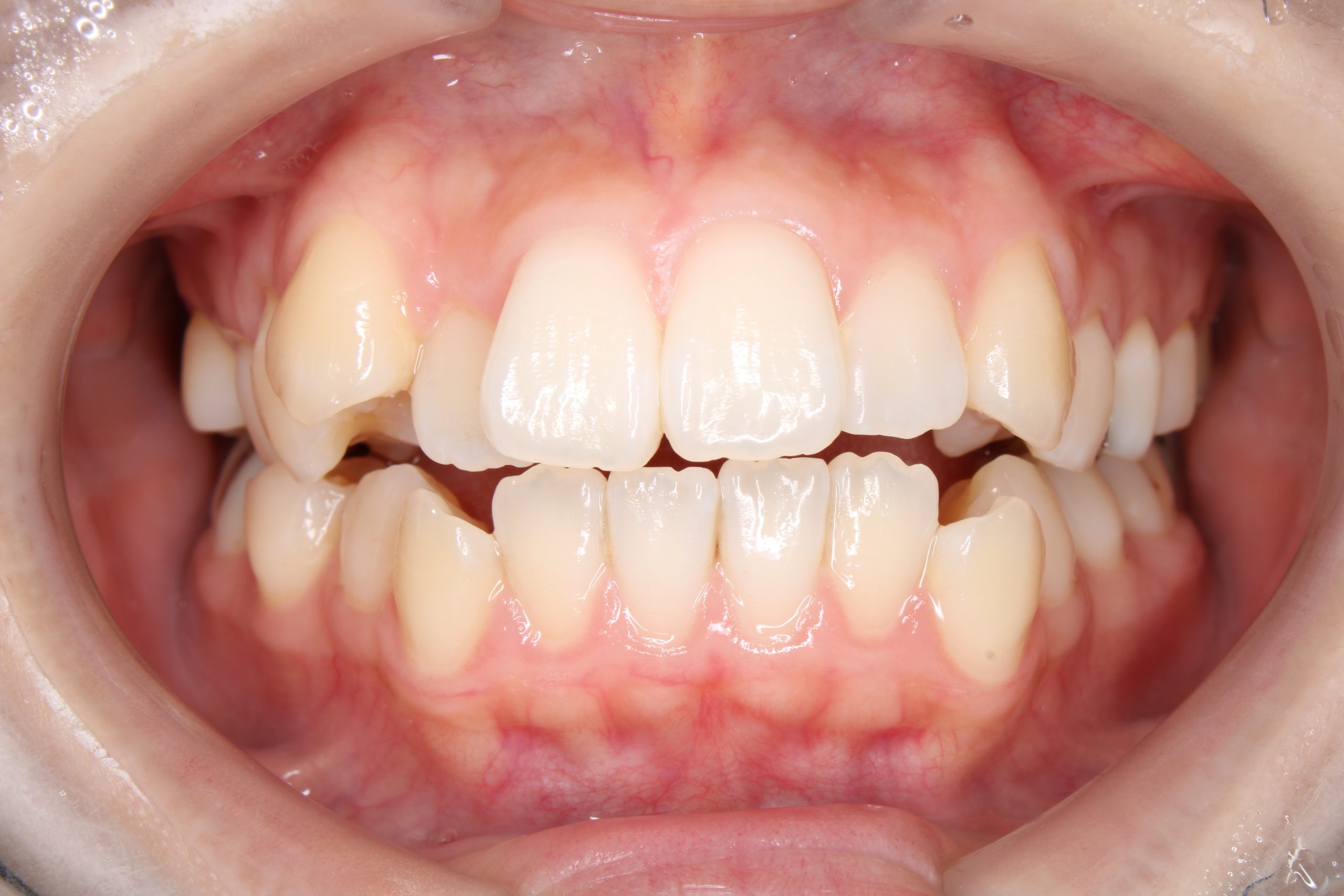 八重歯を治したい₋リンガルの症例