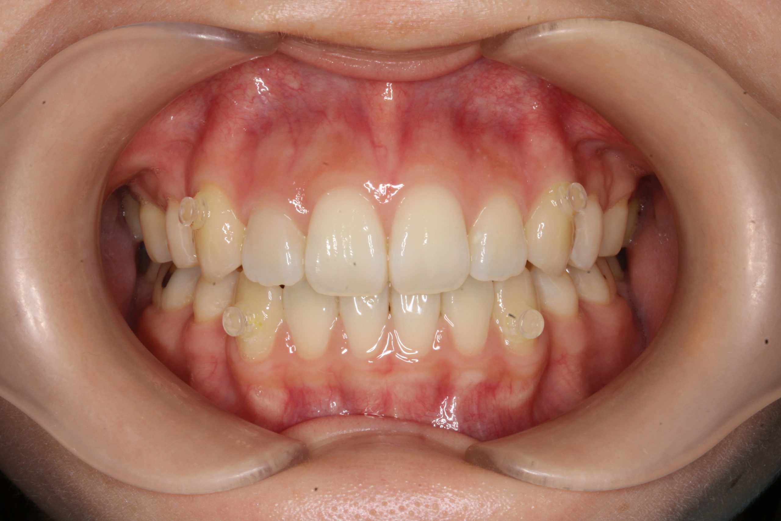 八重歯を治したい₋リンガルの症例