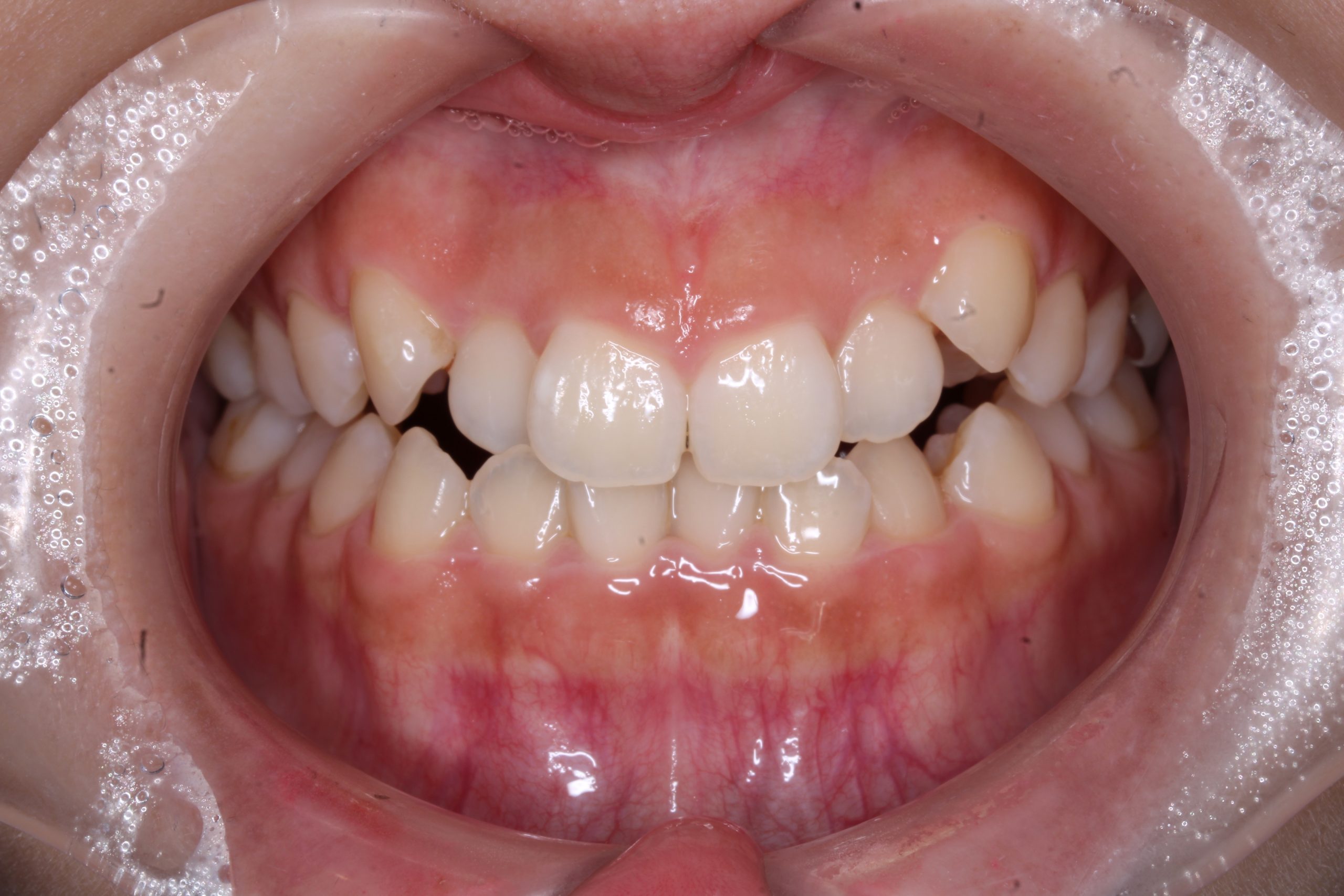 八重歯を治したい₋ハーフリンガルの症例