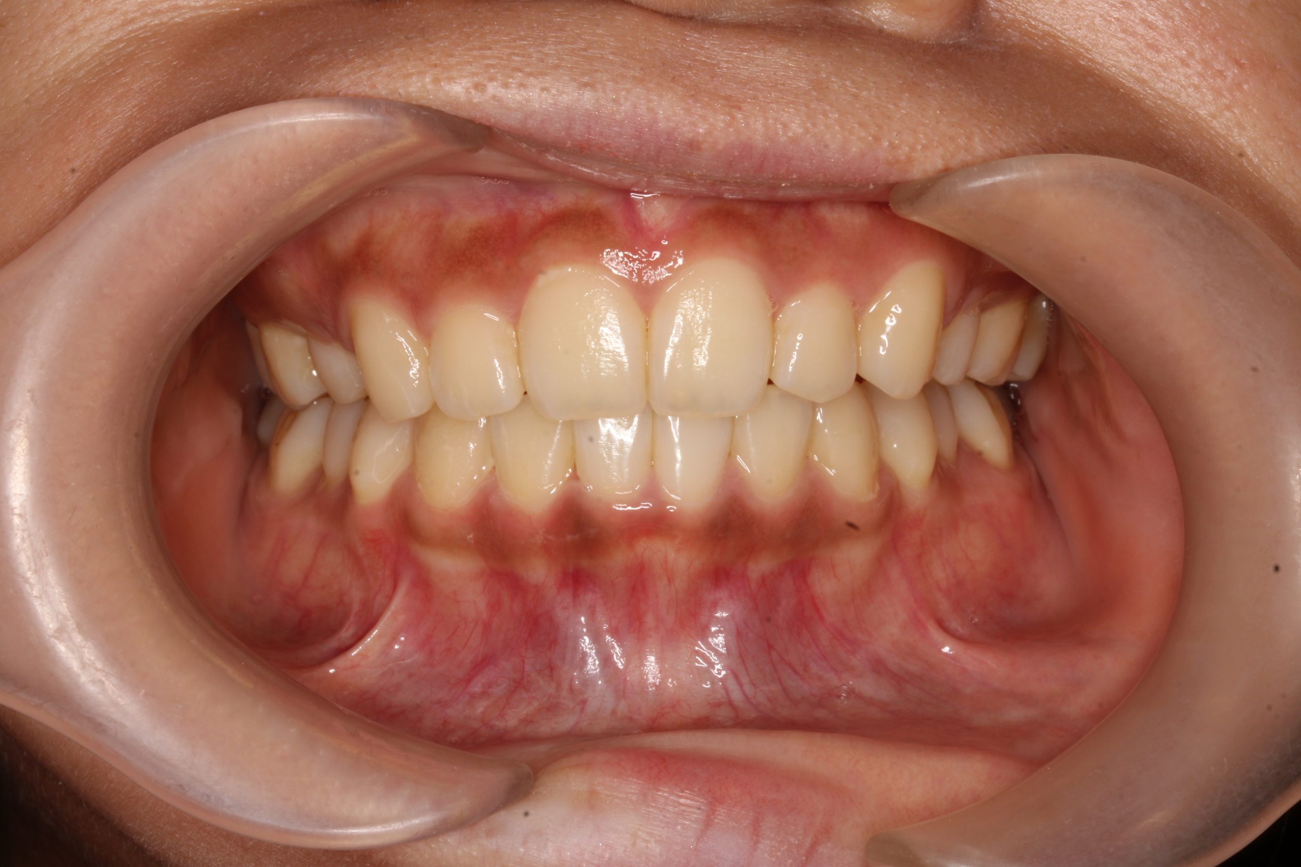 かみ合わせが深い₋リンガルの症例