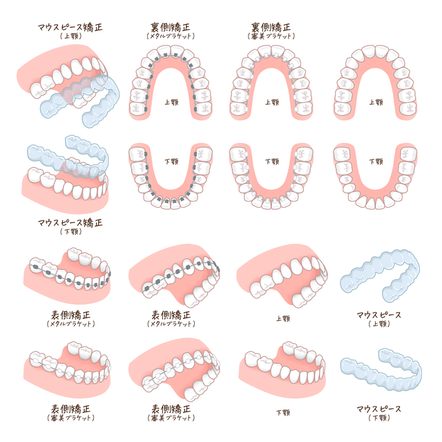 矯正装置　種類　目立たない