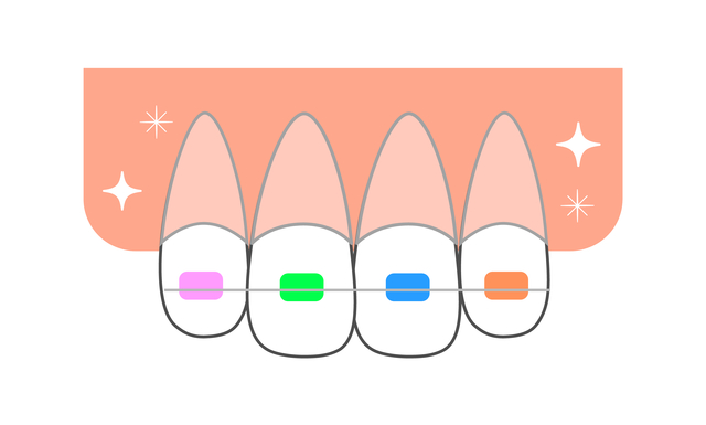 矯正装置　SNS　症例