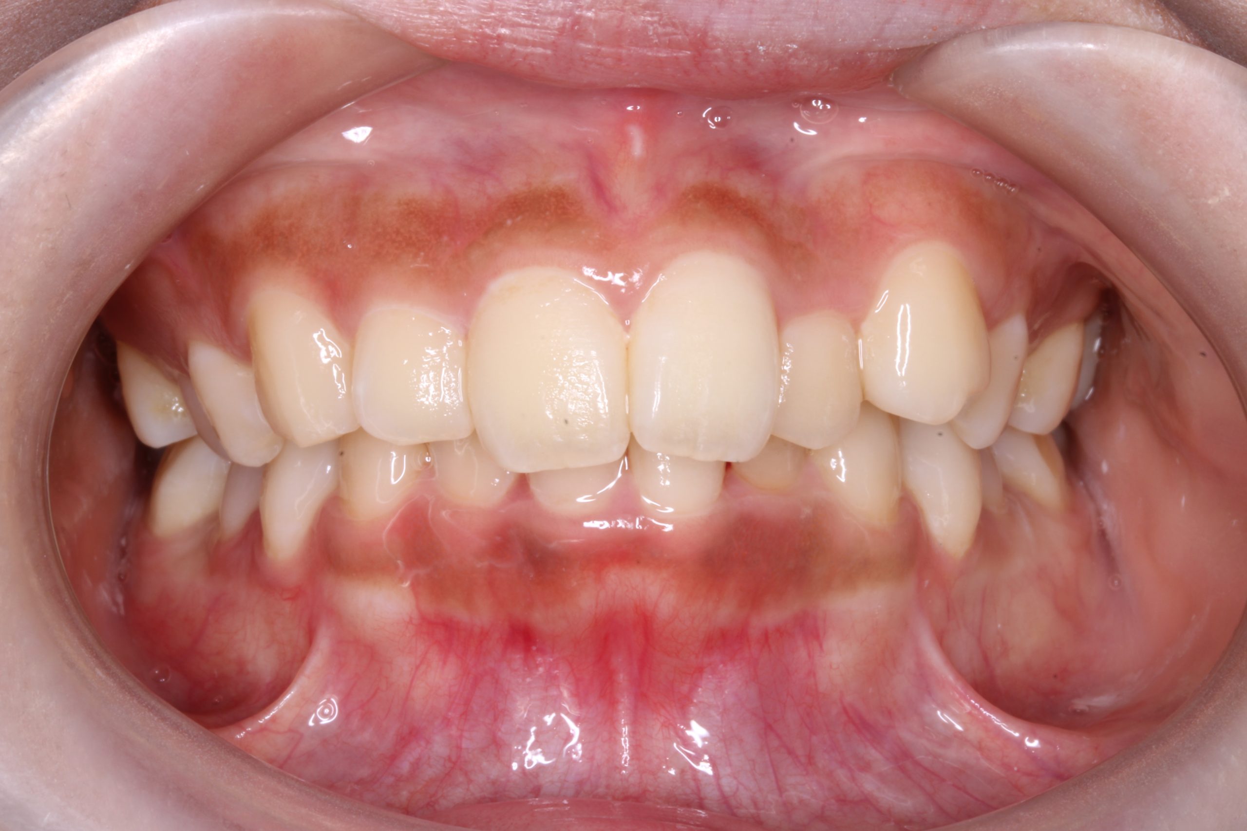 かみ合わせが深い‐リンガルの症例