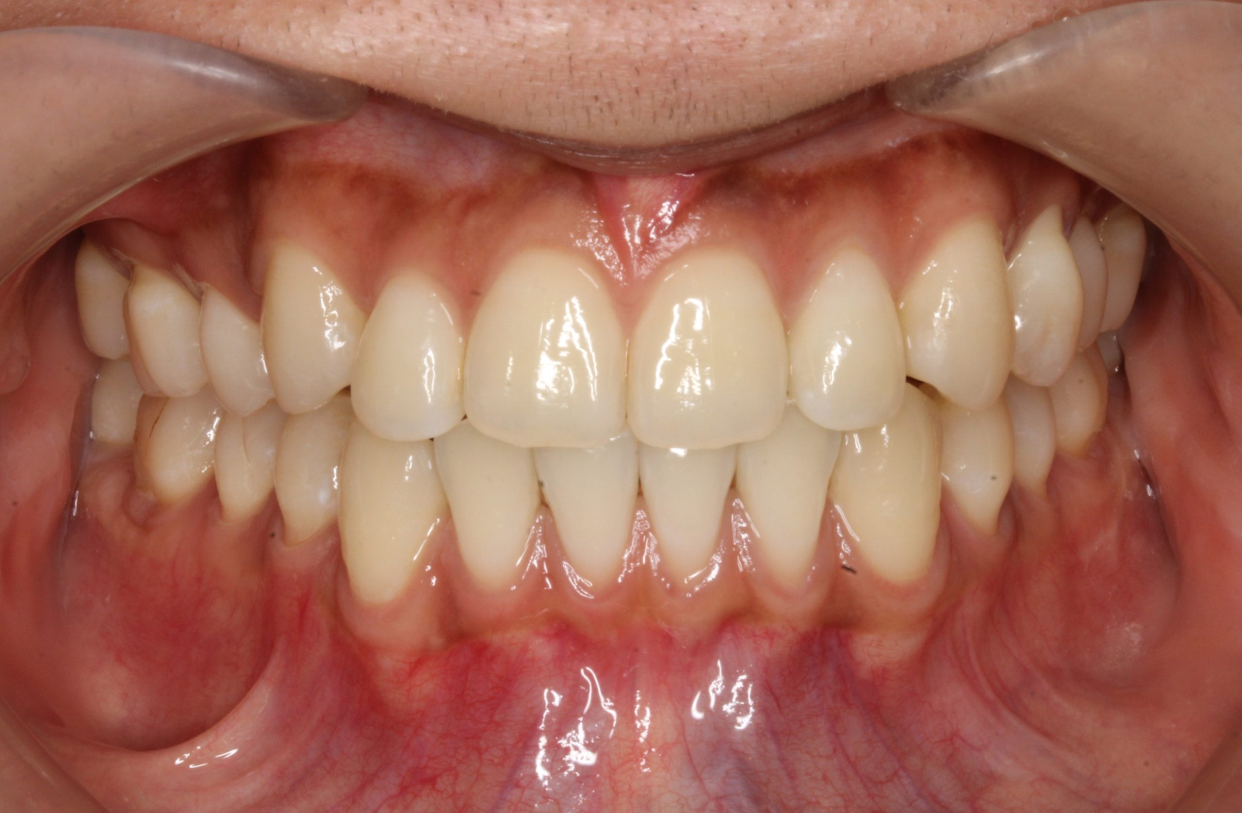 嚙み合わせを治したい‐リンガルの症例