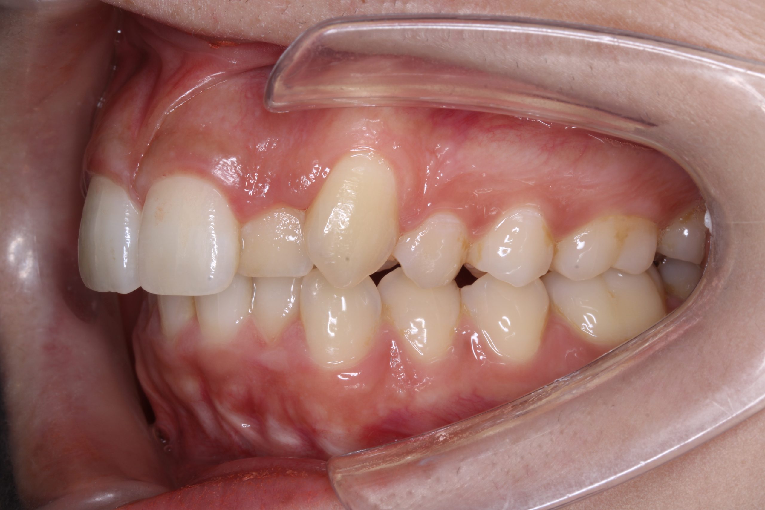 出っ歯を治したい₋ハーフリンガルの症例