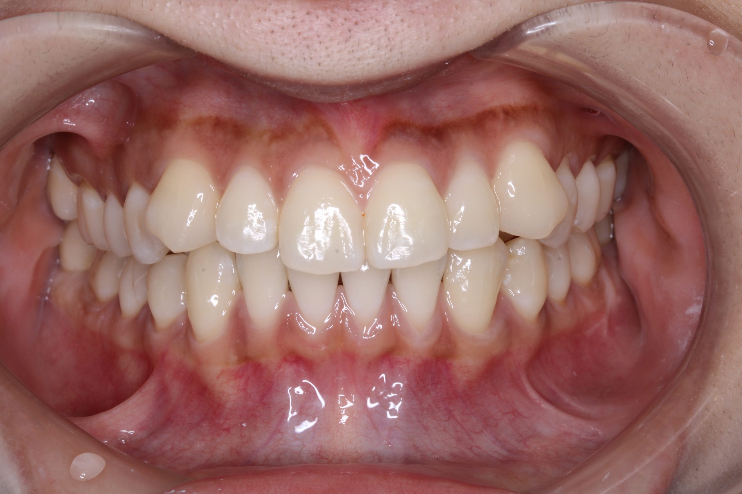 噛み合わせを治したい‐リンガルの症例