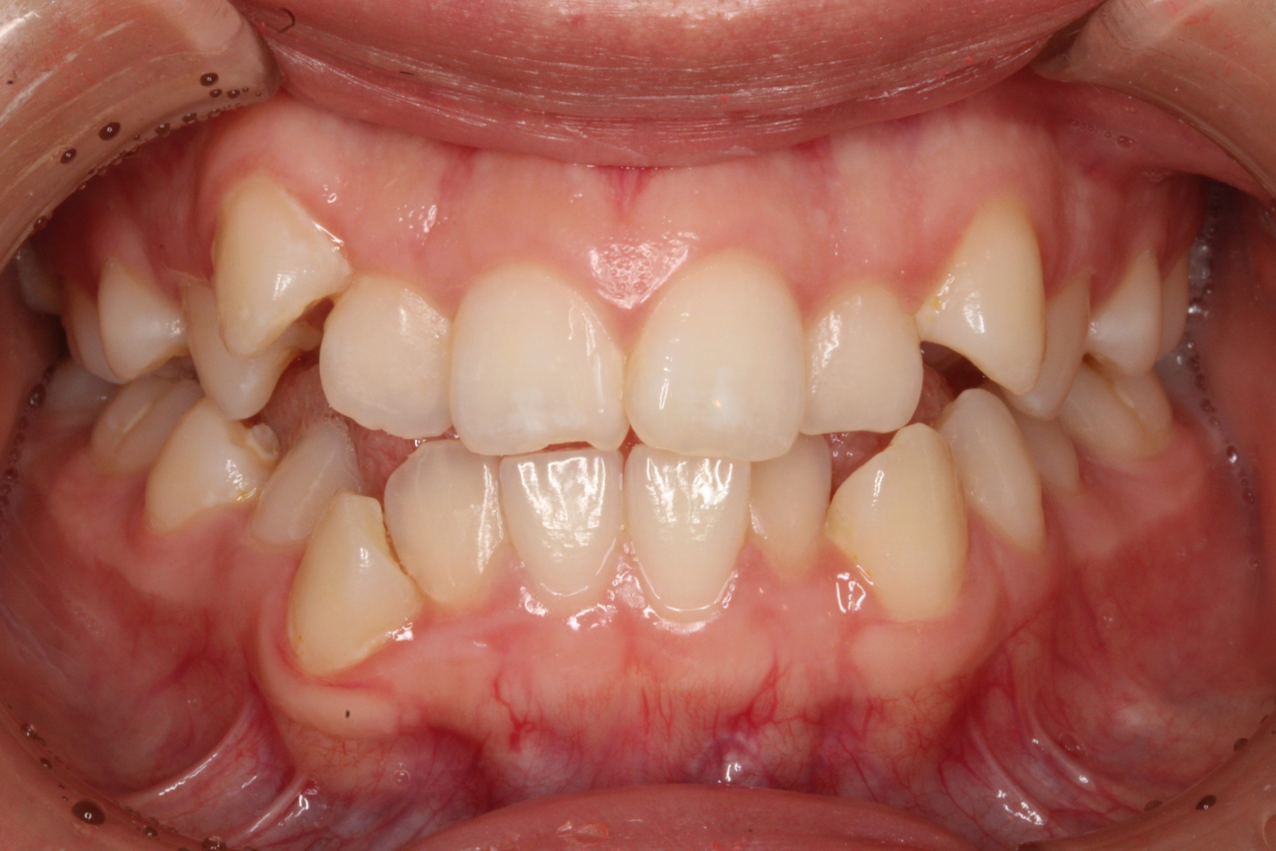 八重歯を治したい‐リンガルの症例