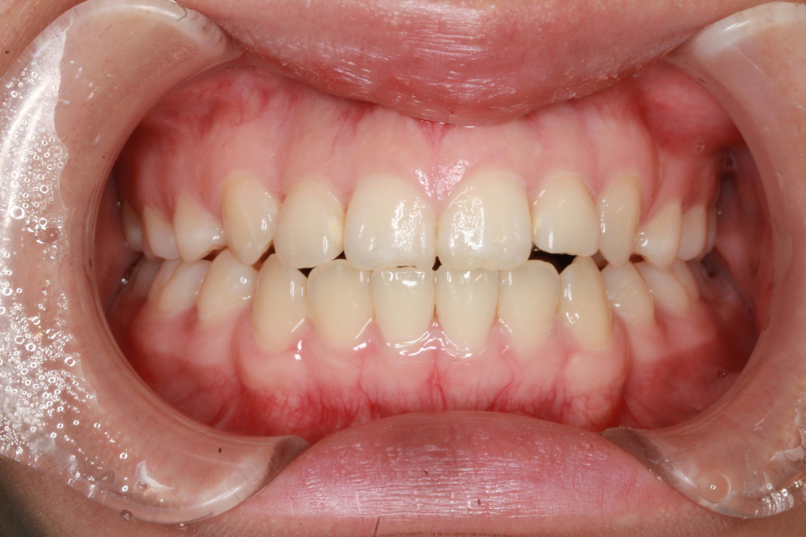 八重歯を治したい‐リンガルの症例