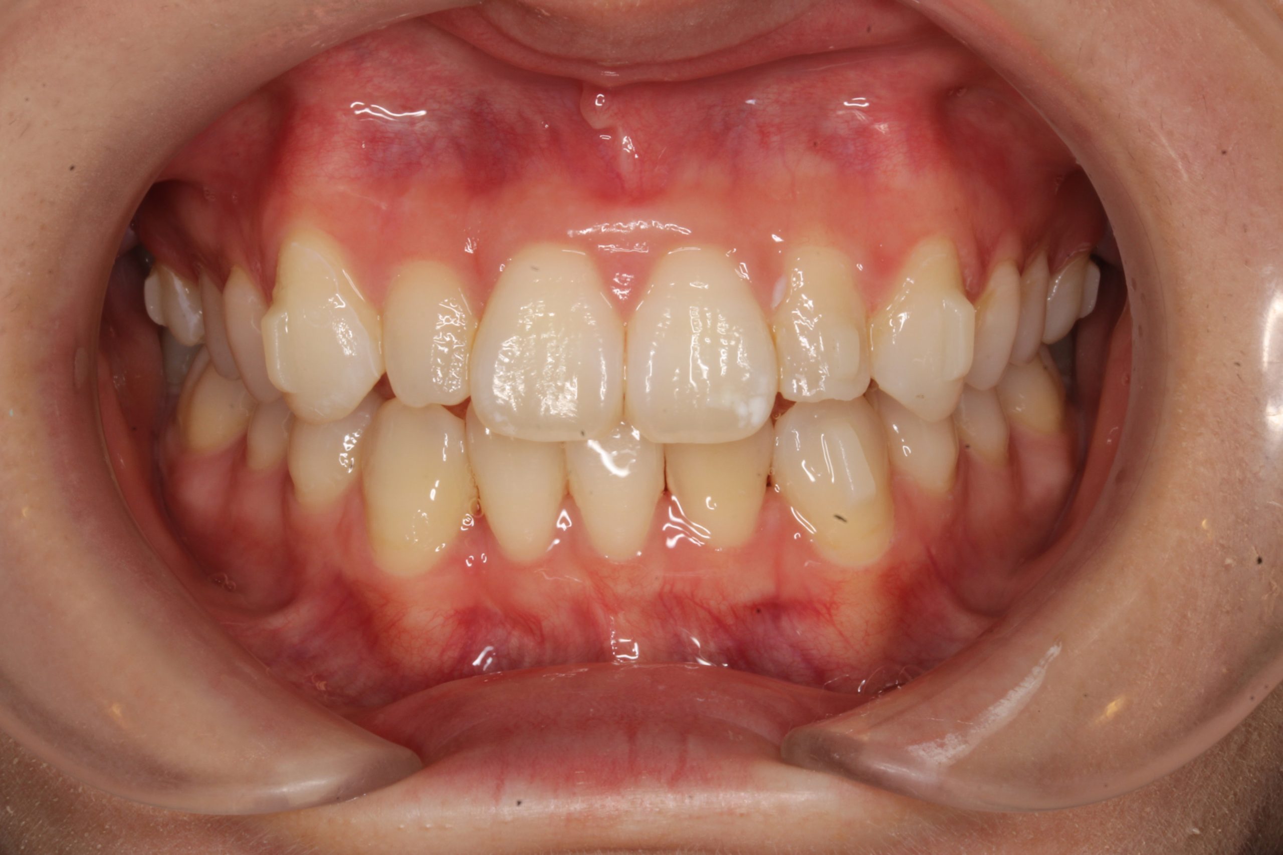 歯の凸凹を治したい₋リンガルの症例