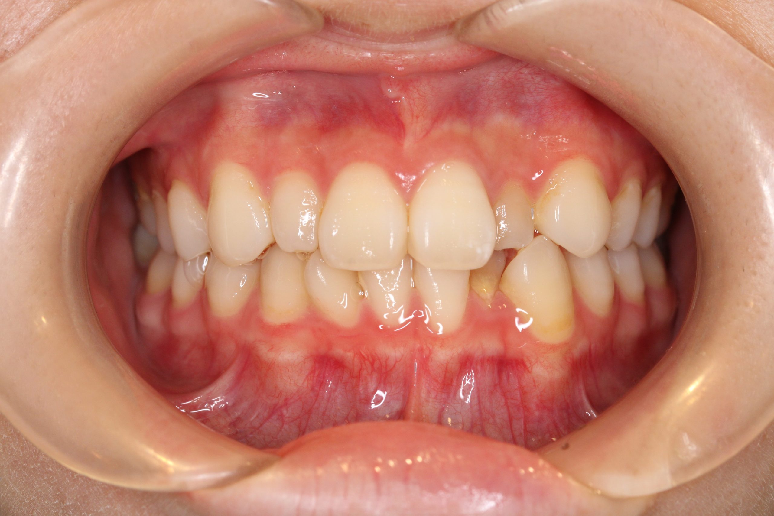 歯の凸凹を治したい₋リンガルの症例