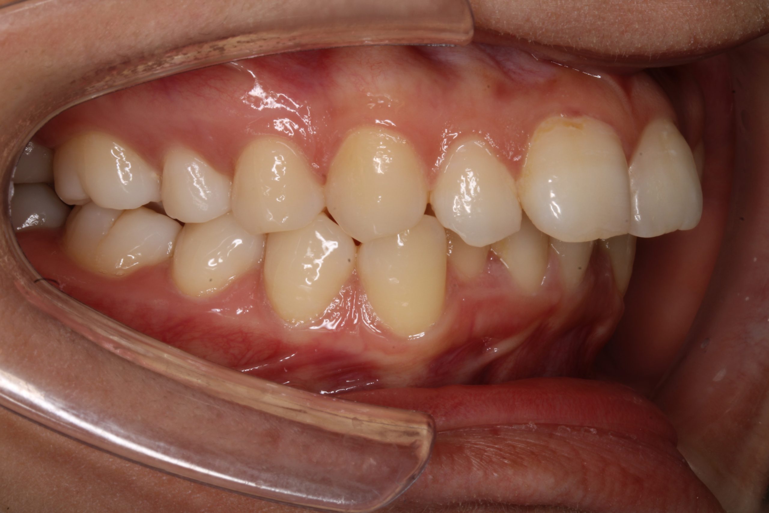 出っ歯を治したい‐ハーフリンガルの症例