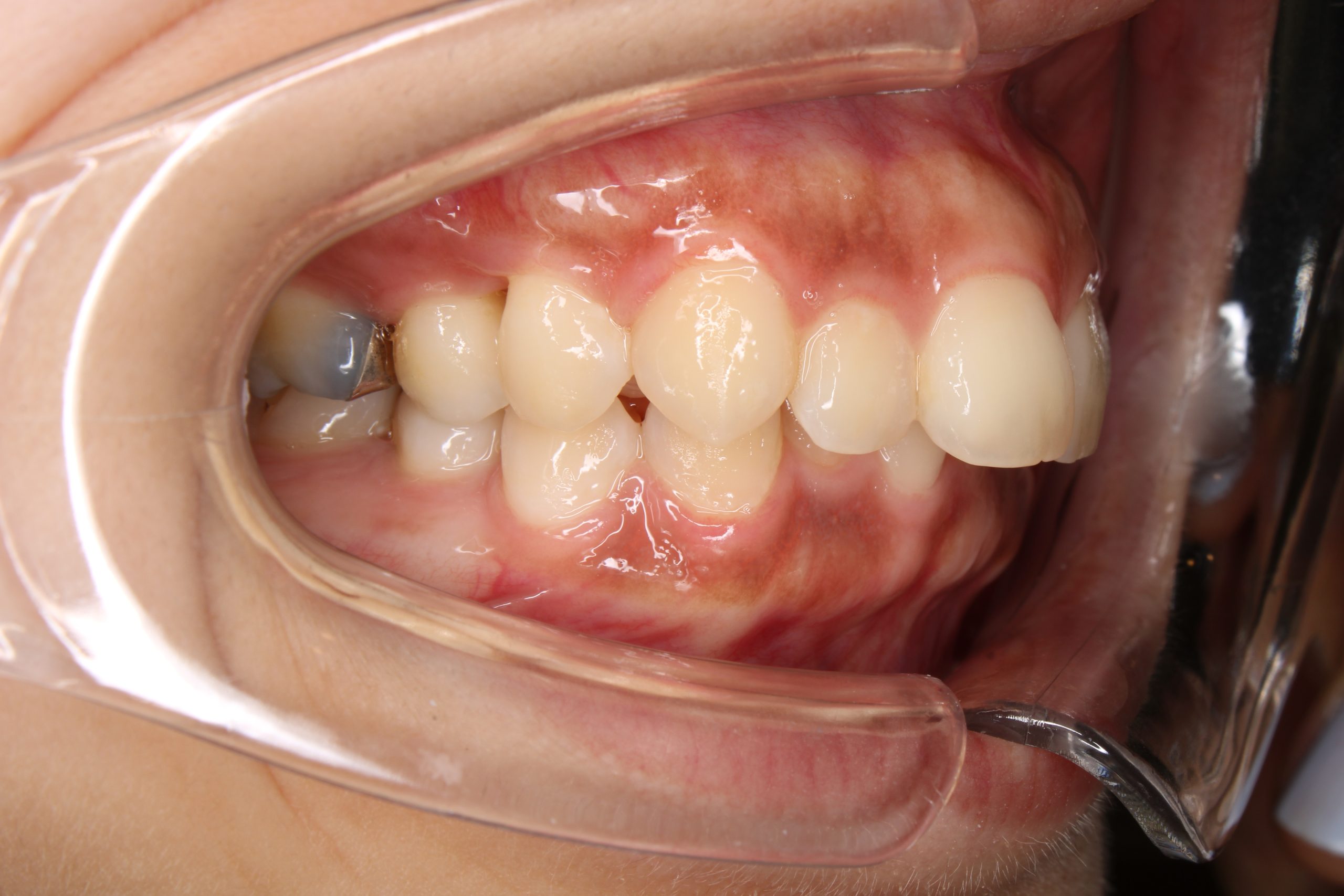 出っ歯を治したい‐リンガルの症例