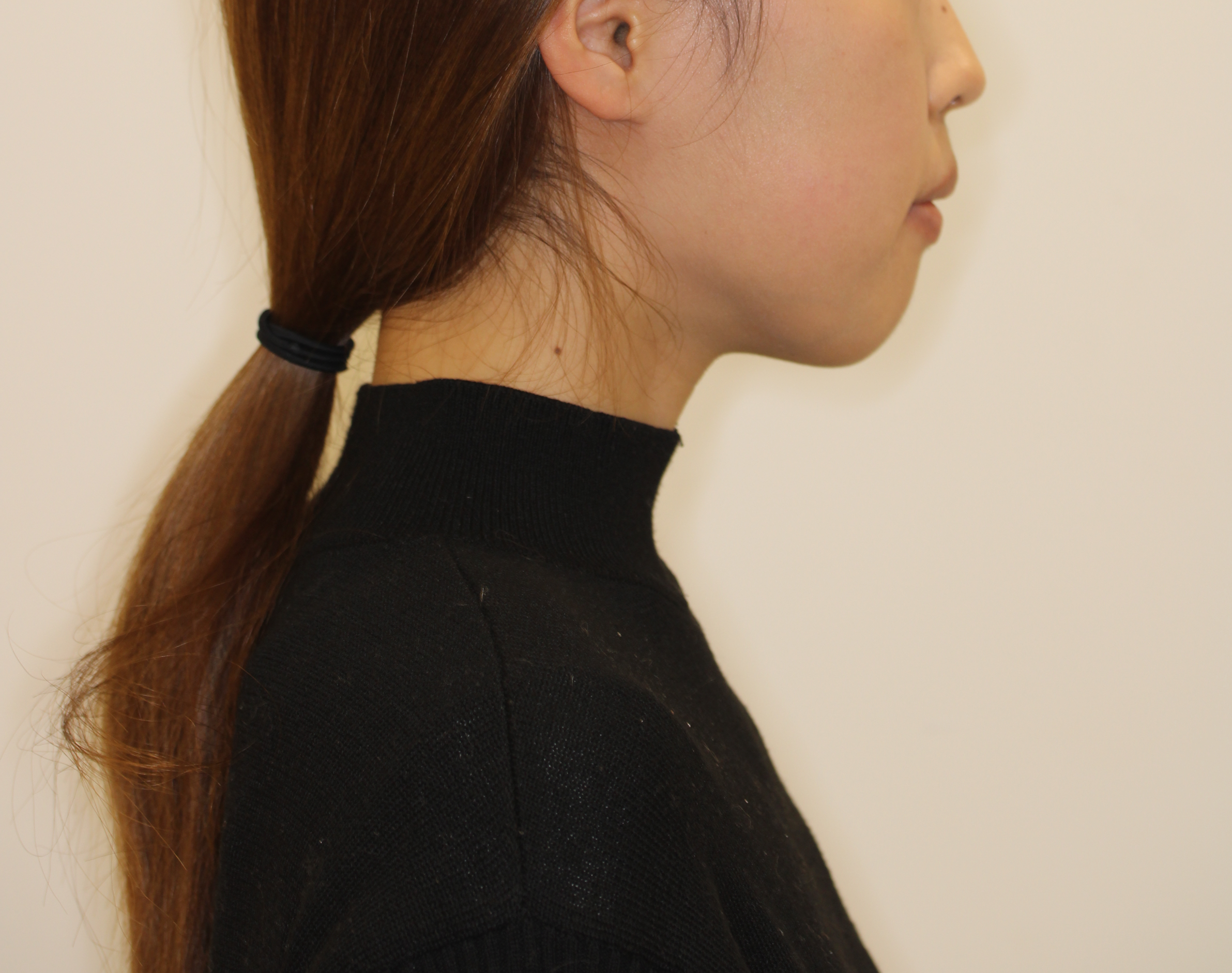 出っ歯を治したい‐リンガルの症例