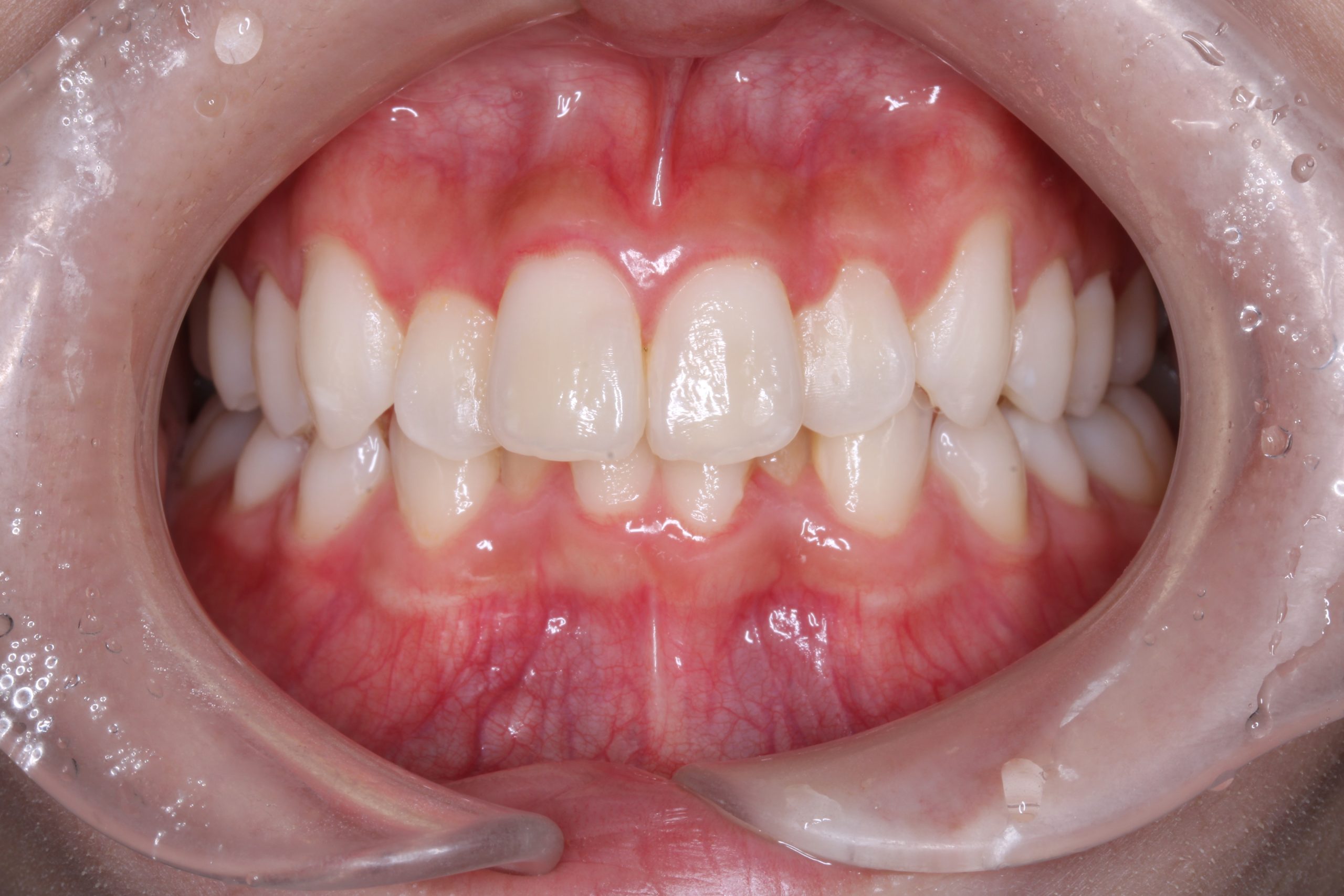 歯の凸凹を治したい₋ハーフリンガルの症例