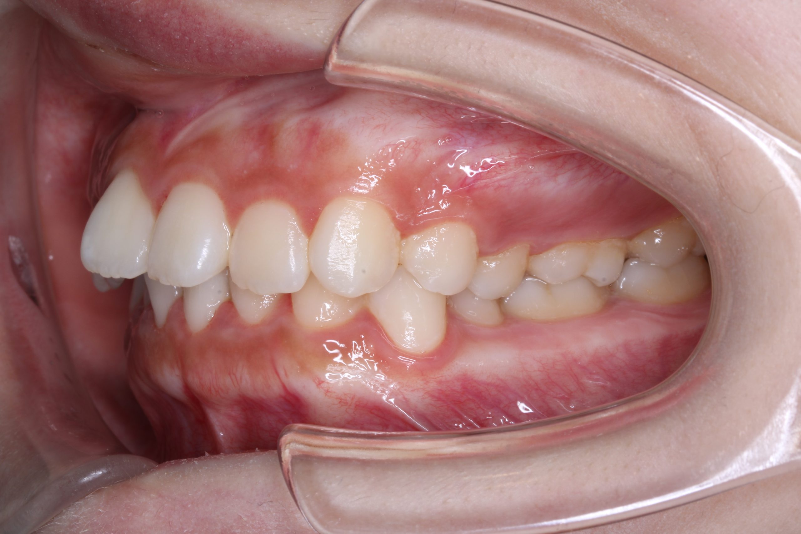 出っ歯・裏側矯正の症例