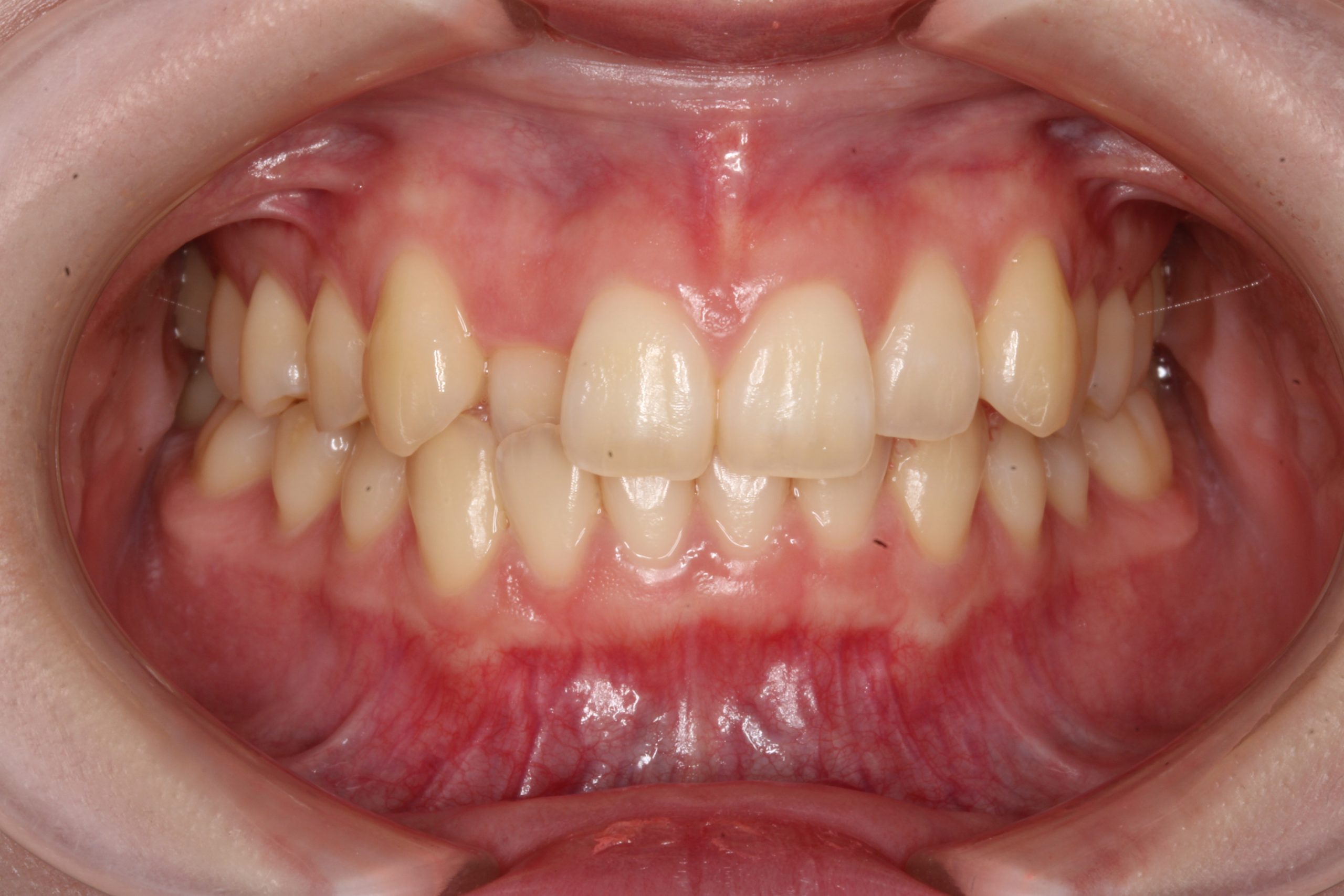 歯の凸凹を治したい‐ラビアルの症例