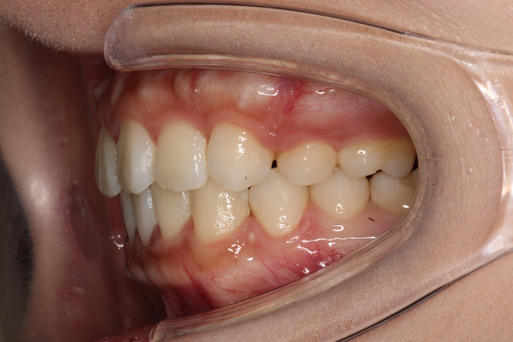 出っ歯・裏側矯正の症例