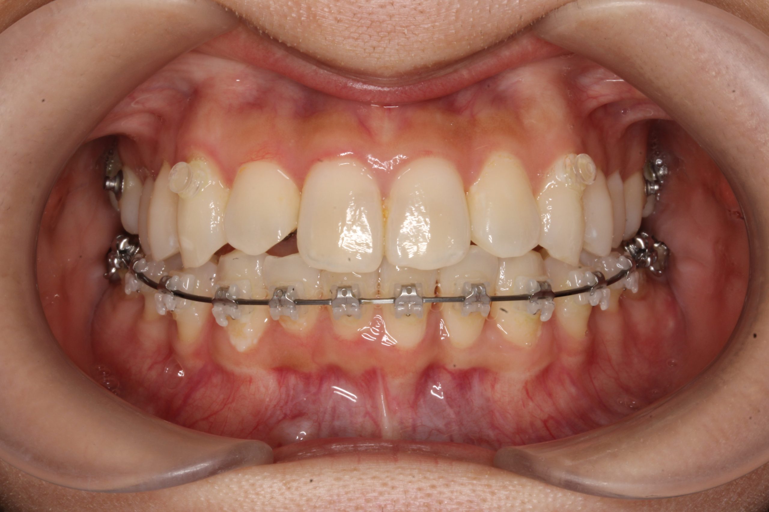 歯の凸凹を治したい₋ハーフリンガルの症例