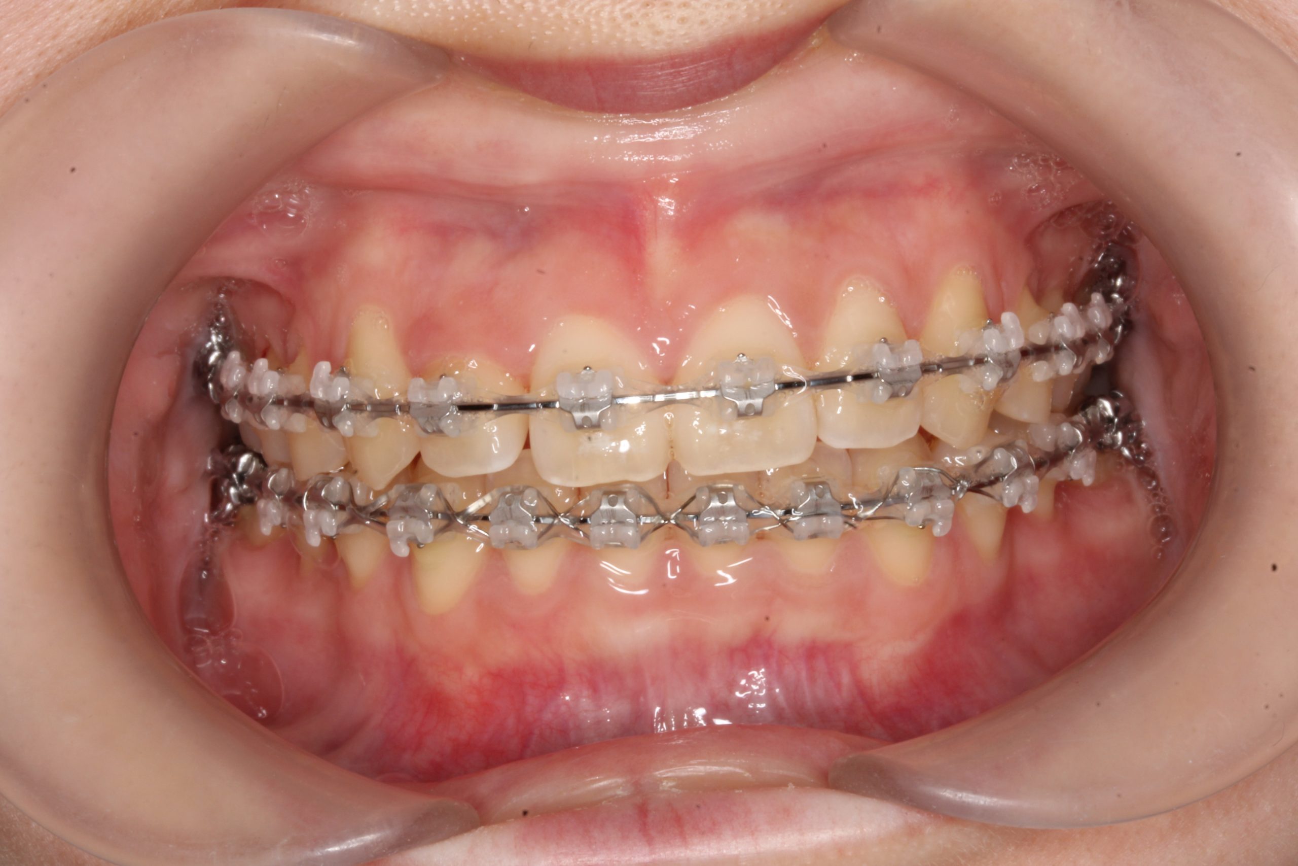 歯の凸凹を治したい₋ラビアルの症例